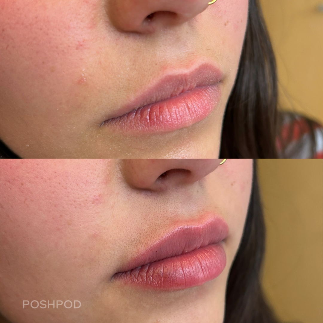 First-time filler client before and after – gentle, natural lip boost