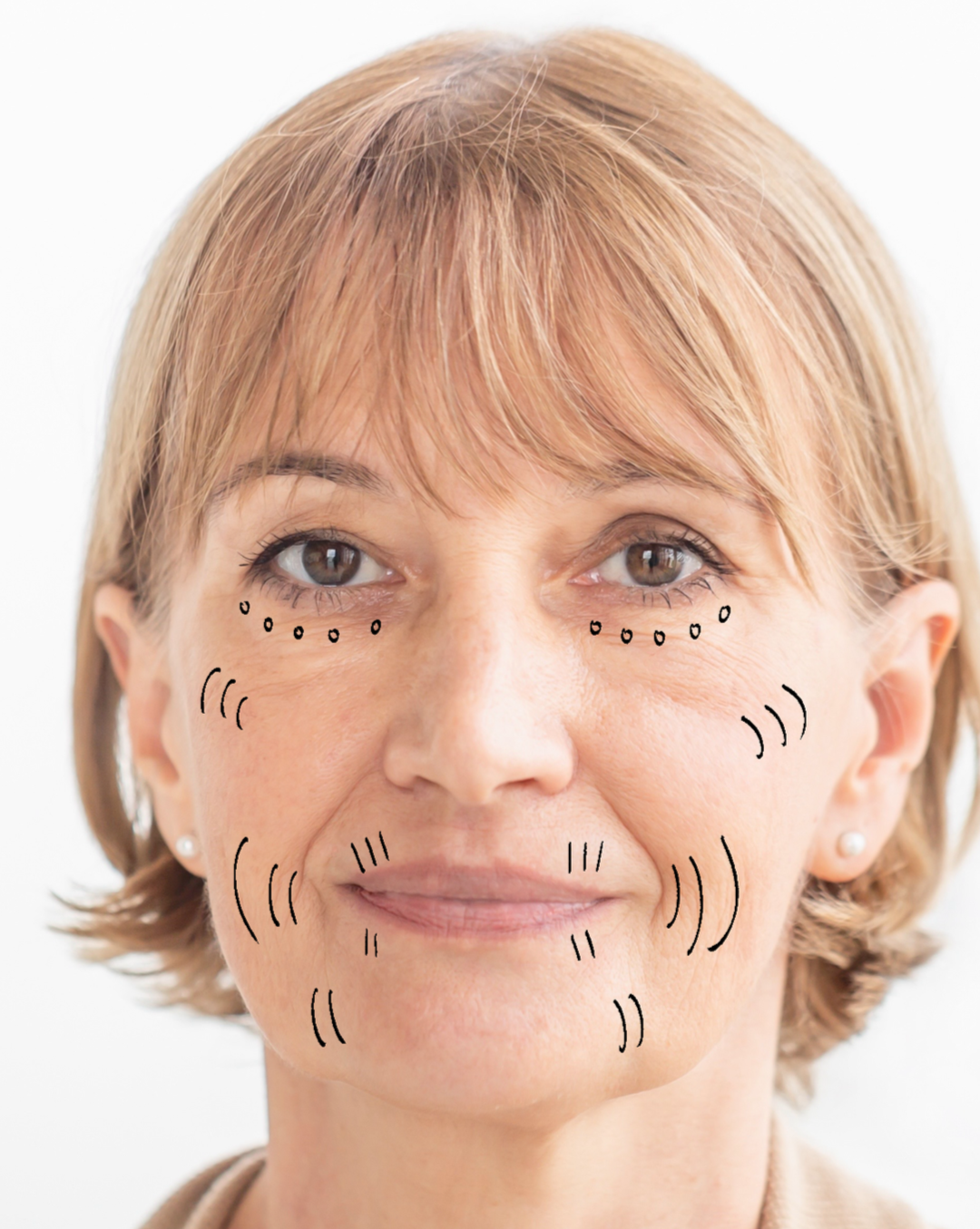 Skinvive injectable treatment designed to improve skin hydration, texture, and surface quality for smoother, healthier-looking skin.