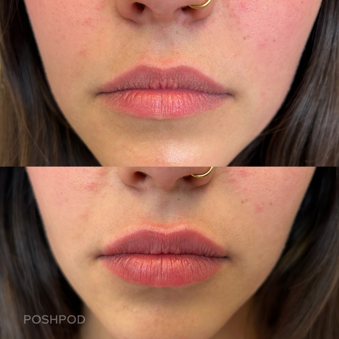 Lip filler photo comparison – front view results 2 weeks post injection Denver