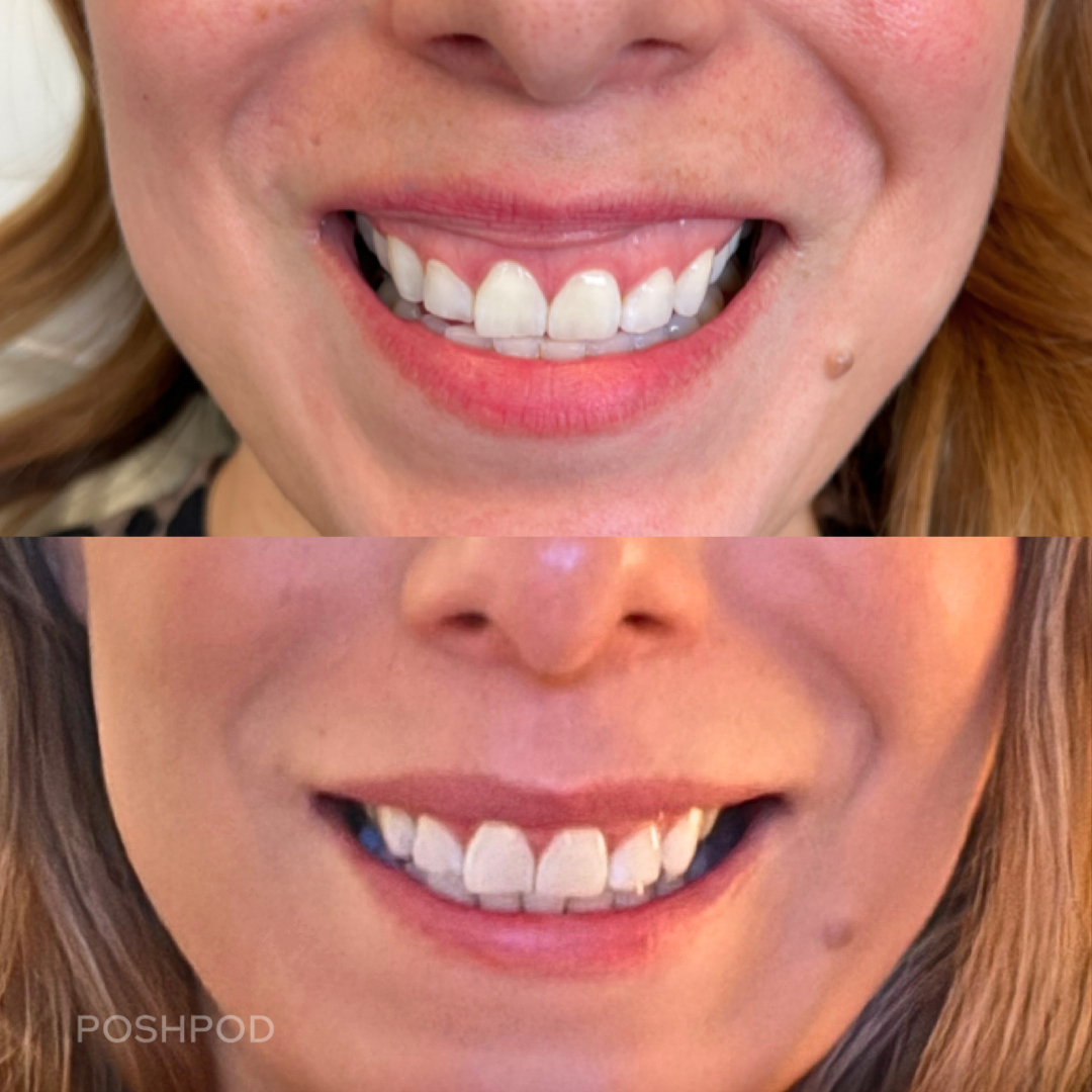 Lip Flip for gummy smile, botox in lips denver