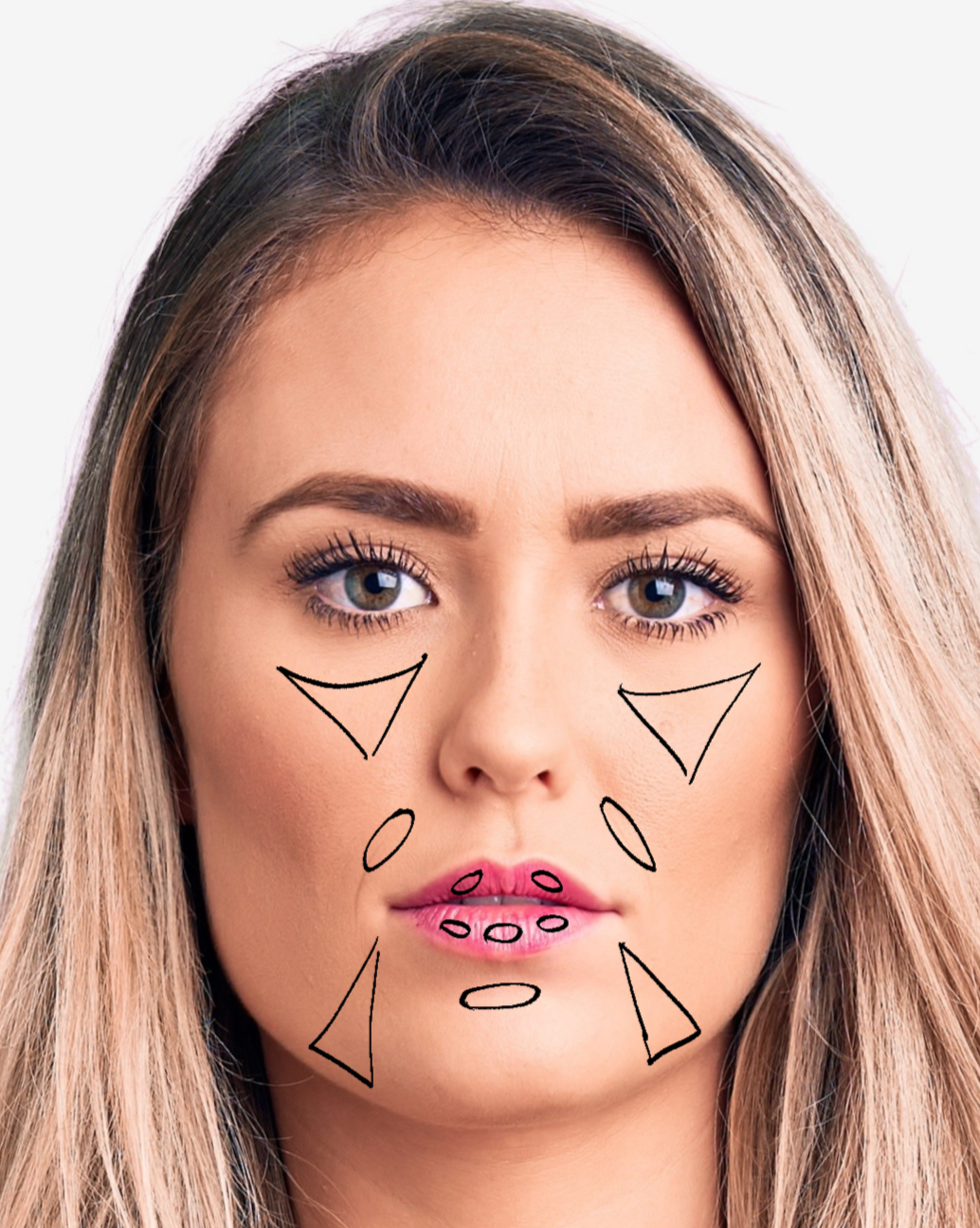 Full-syringe dermal filler treatment enhancing lips and softening nasolabial folds and marionette lines for natural facial rejuvenation in Lakewood.