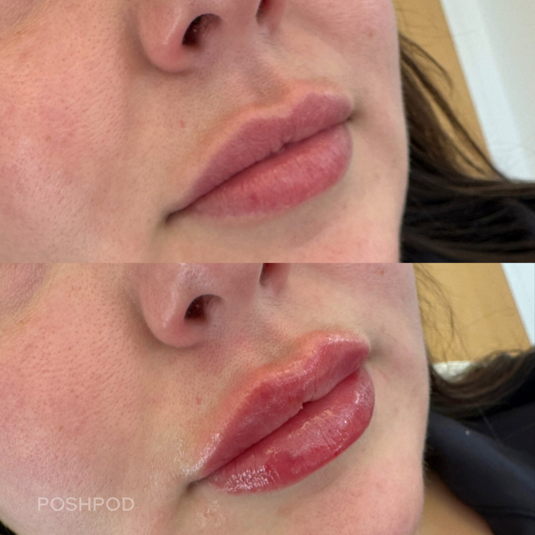 Natural Lip Filler Before and After at Lakewood Med Spa
