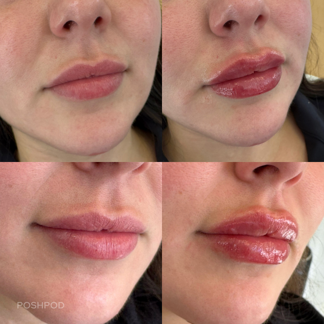 Natural Lip Filler Before and After Photos by Certified Injector Ashley Zhivotovsky Lakewood