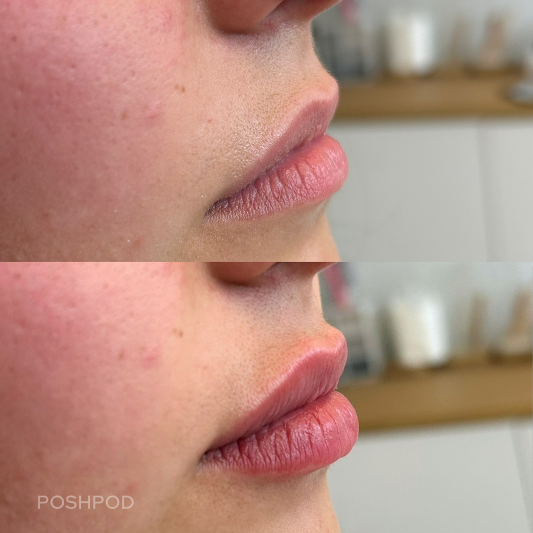 Before and after lip filler treatment with added projection and hydration Denver