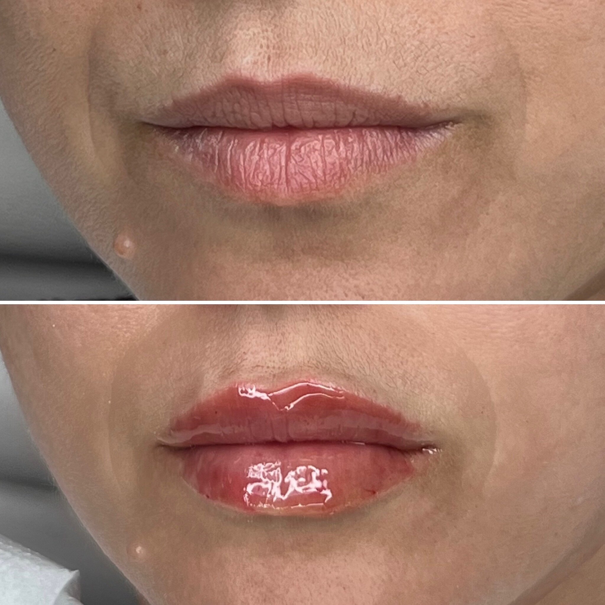 Minimal Filler, Maximum Results 💫
A beautiful natural lip enhancement 🥰 Maximising results using minimal filler to lift her top lip adding more volume.

Are you more for natural lip filler or Russian lips?