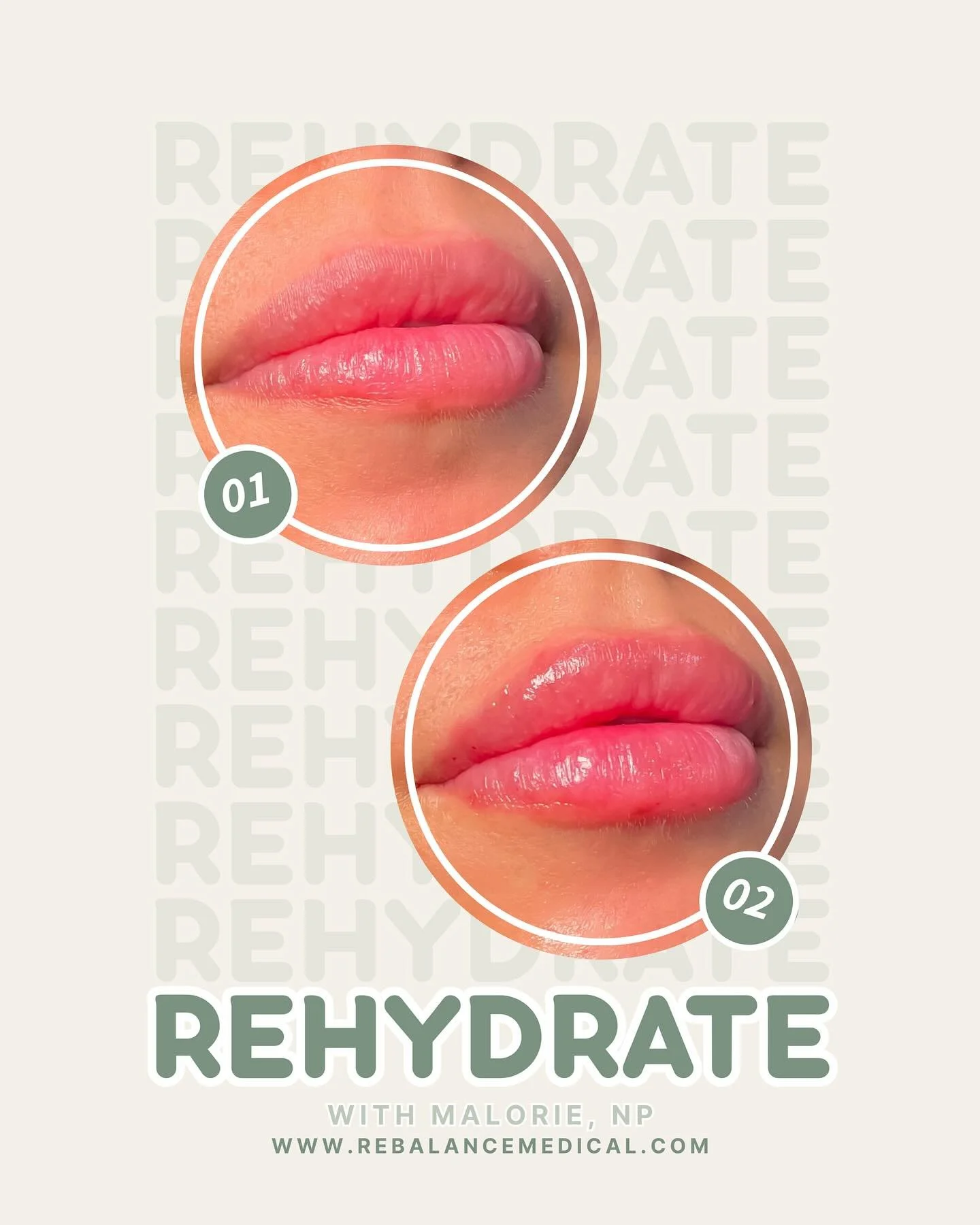 As the weather cools down, our lips are one of the first places to lose moisture&mdash;leading to dryness, fine lines, and a lack of definition.
At ReBalance Medical, we use hyaluronic acid-based lip filler not just for volume, but to deeply rehydrat