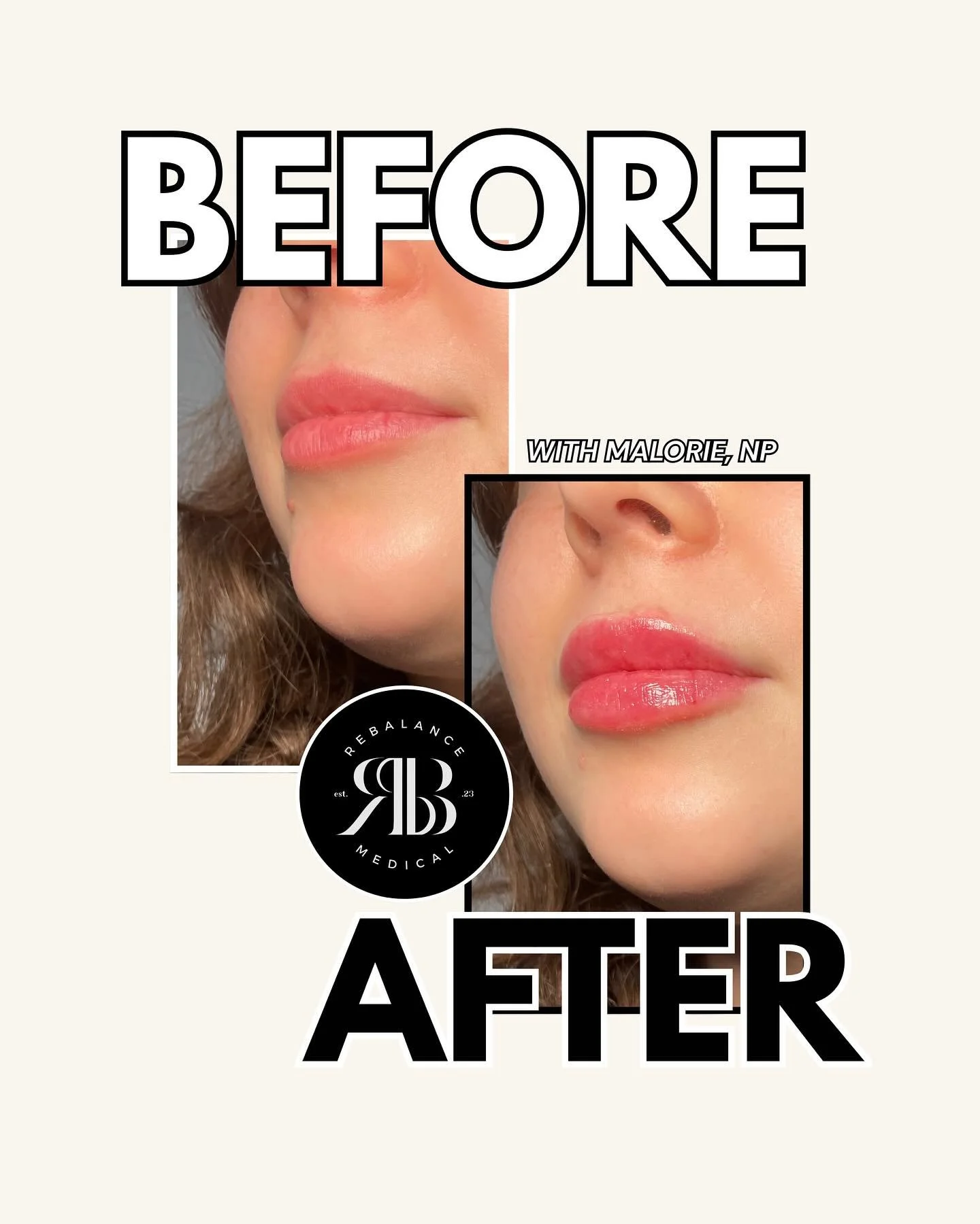 Curious about lip filler? It&rsquo;s a quick, non-surgical way to add volume, smooth lines, and enhance the natural shape of your lips. Results are instant, with full effects showing in just a few days as the filler settles in.
Whether you want a sub