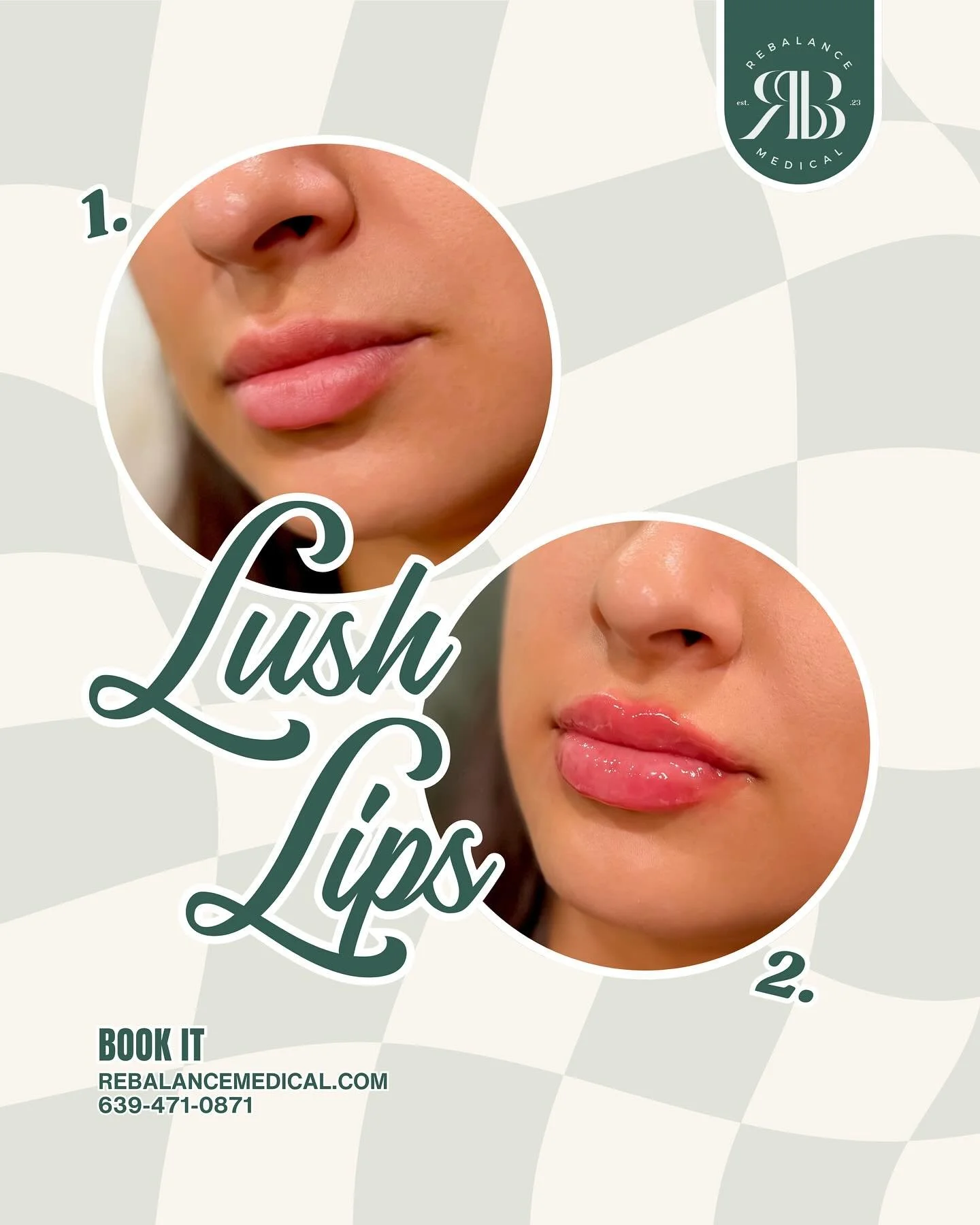 Lush lips, perfected. Add volume, definition, and hydration with hyaluronic acid injections for a soft, natural finish.
Book now for a subtle enhancement that speaks volumes.

#hyaluronicacidfillers #lipfiller #dermalfiller #fallrefresh #fillers #fil