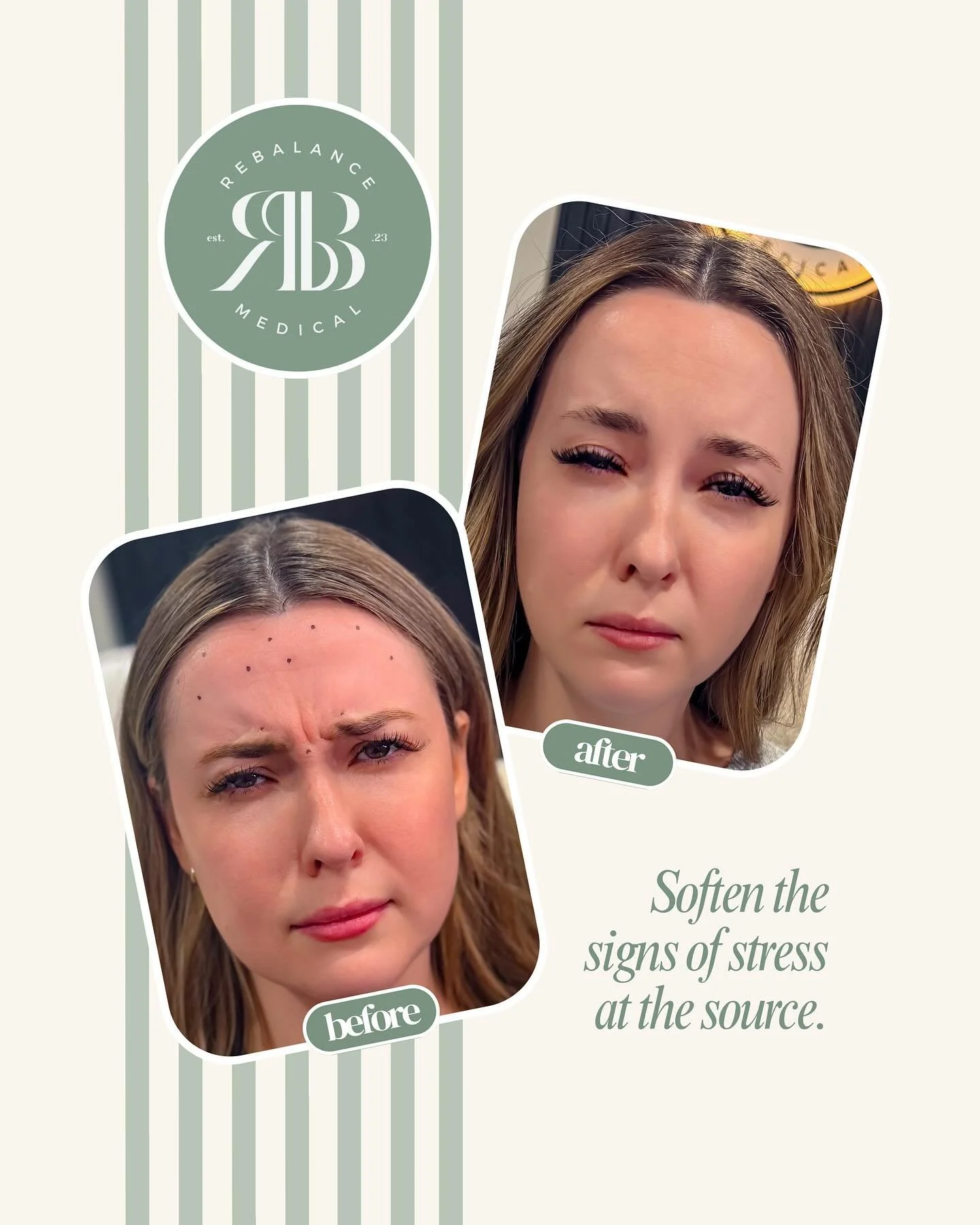 Bo/tox injections target the muscles that cause stress-related wrinkles and fine lines, softening the appearance of tension and fatigue on your face. By relaxing these muscles, the treatments create a smoother, more refreshed look that helps you feel