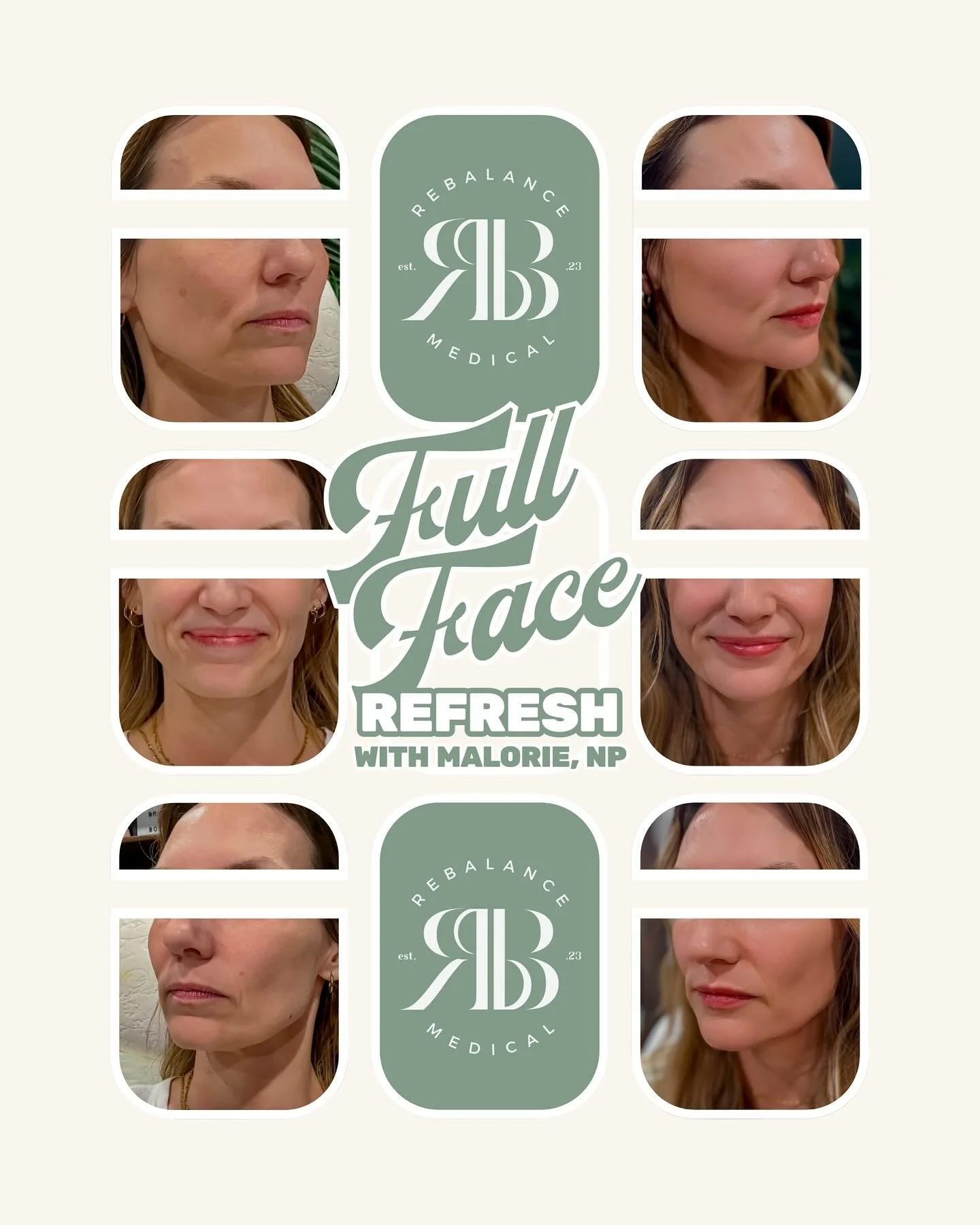 A beautifully balanced, rejuvenated look &mdash; achieved through a customized combination of hyaluronic acid filler and anti-wrinkle injections.
Each treatment is tailored to enhance harmony and restore youthful structure: 💧 Tox: forehead, frown li