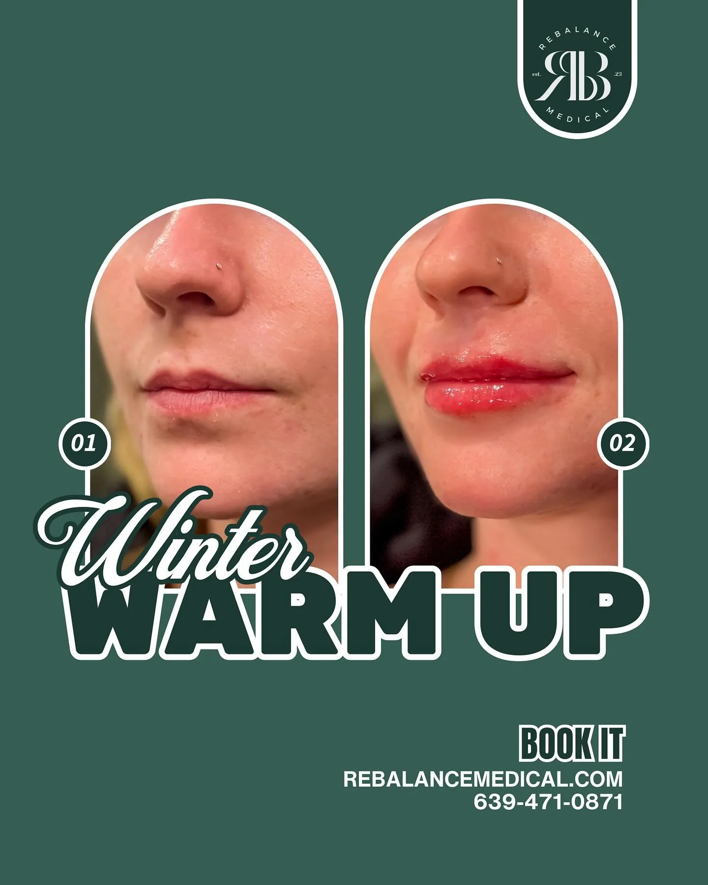 Have you booked your winter warm-up yet? This cozy season calls for soft, hydrated, fuller lips! Limited appointments available &mdash; book yours today!

#medicalaesthetics #aestheticinjector #injectables #lipfiller #dermalfiller #hafiller #aestheti