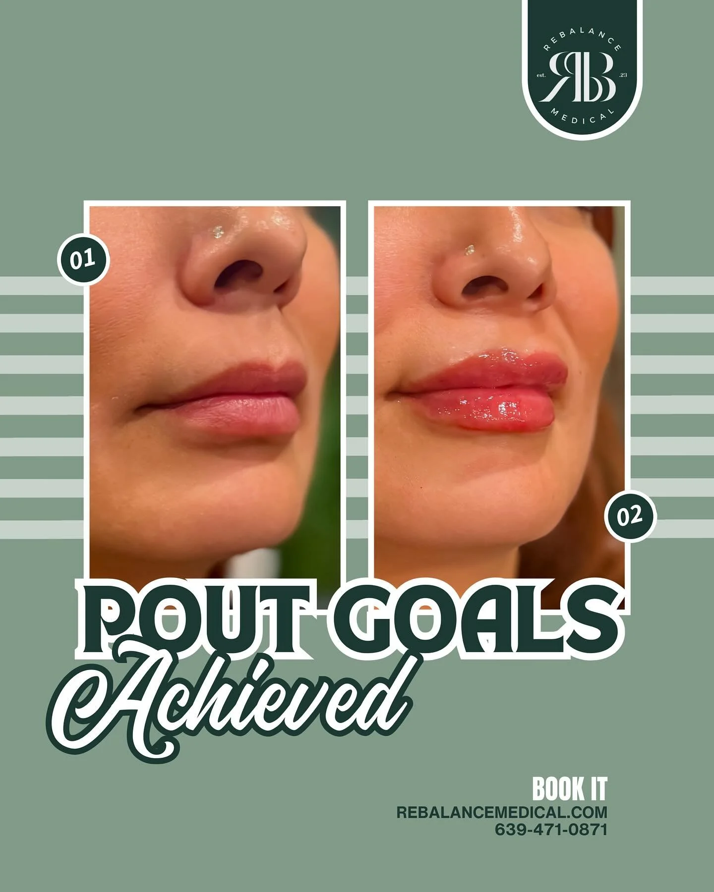 Did you know that hyaluronic acid (HA) injections do more than just add volume to your lips? At ReBalance Medical, we use HA to enhance your natural lip shape, restore symmetry, and improve hydration&mdash;giving you a soft, balanced, and youthful lo