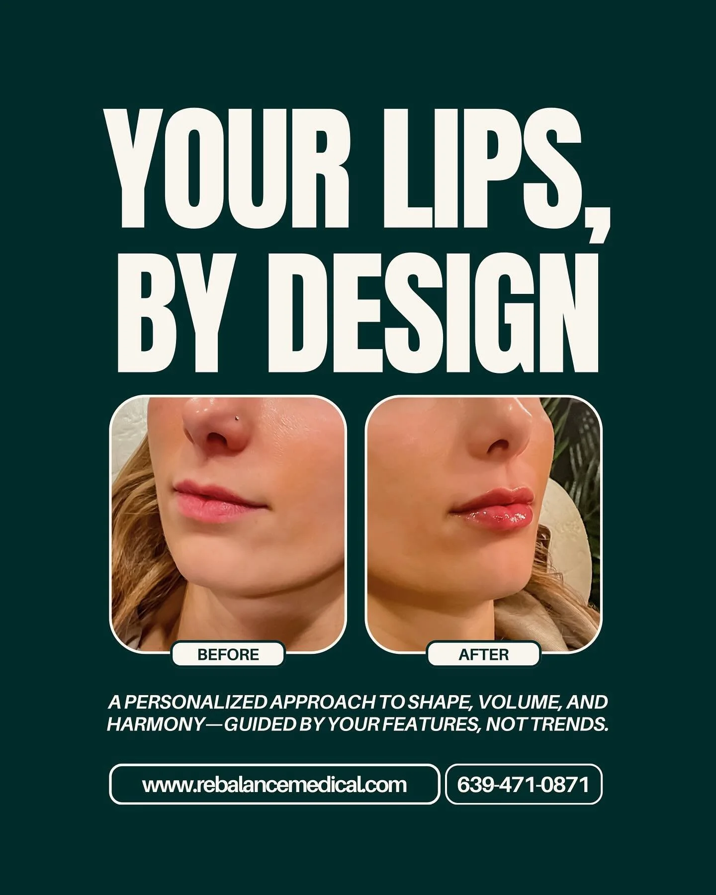 True harmony comes from understanding structure, proportion, and individuality.
That&rsquo;s where our approach begins.

#lipfiller #lipflip #lipinjections #lips #facialbalancing #lipenhancement #hyaluronicacidfillers #hyaluronicacid #filler #dermalf