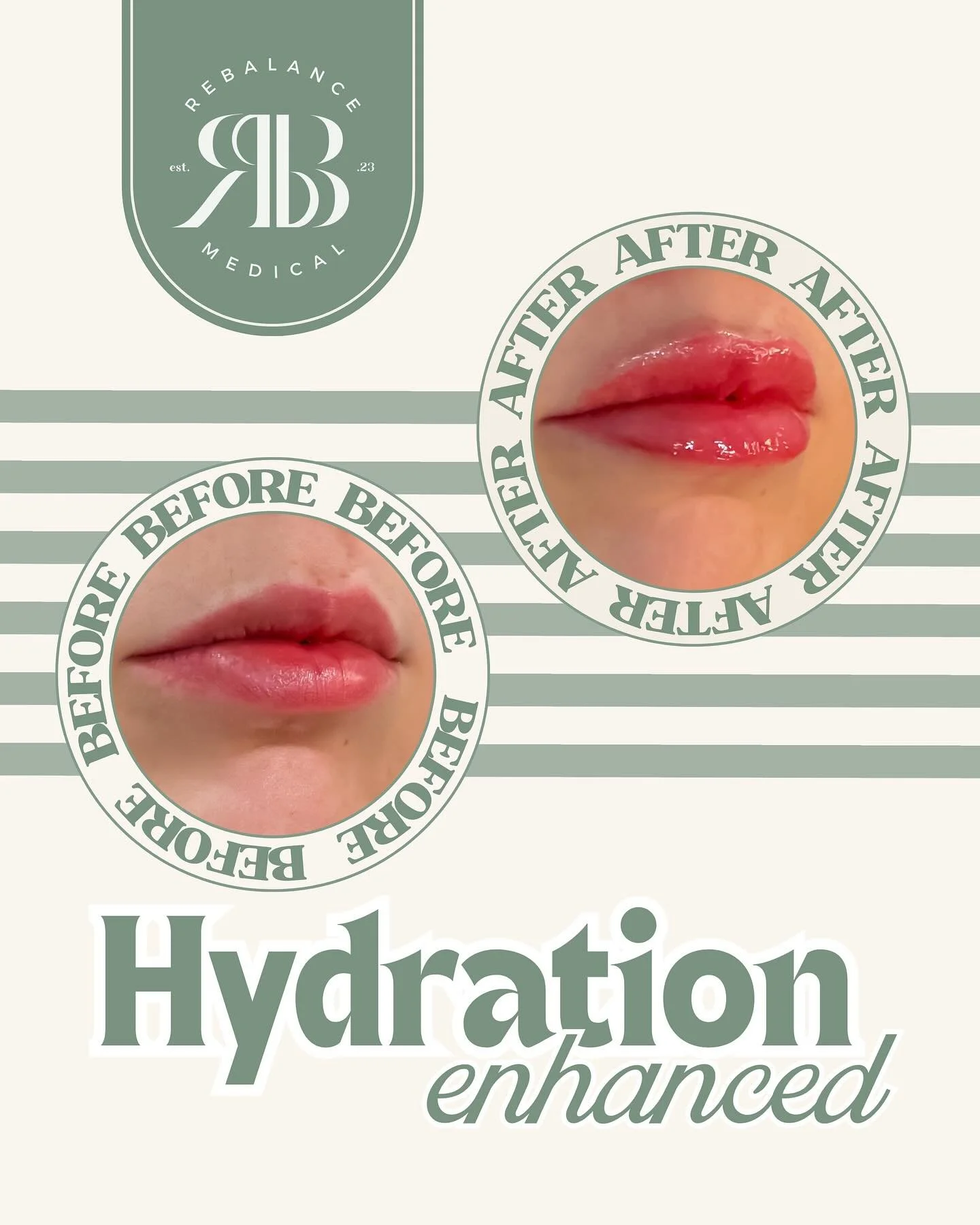 Dry, tired lips?
Hyaluronic acid&ndash;based lip filler helps attract and retain moisture, giving lips a smoother, more hydrated appearance&mdash;without overfilling.

#lipfiller #yxeinjectors #medicalaesthetics #hyaluronicacidfiller #saskatoon