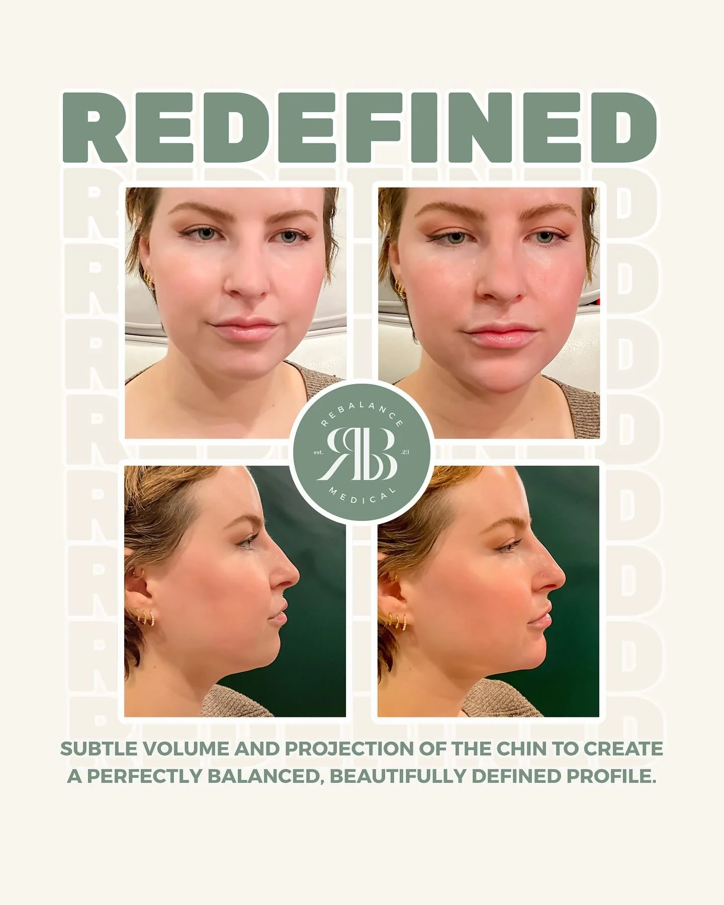 A redefined jawline with chin filler can enhance projection, sharpen contours, and create beautiful facial balance all without surgery. This transformation is all about harmony, not heaviness.
Ready to elevate your profile? Book your consultation wit