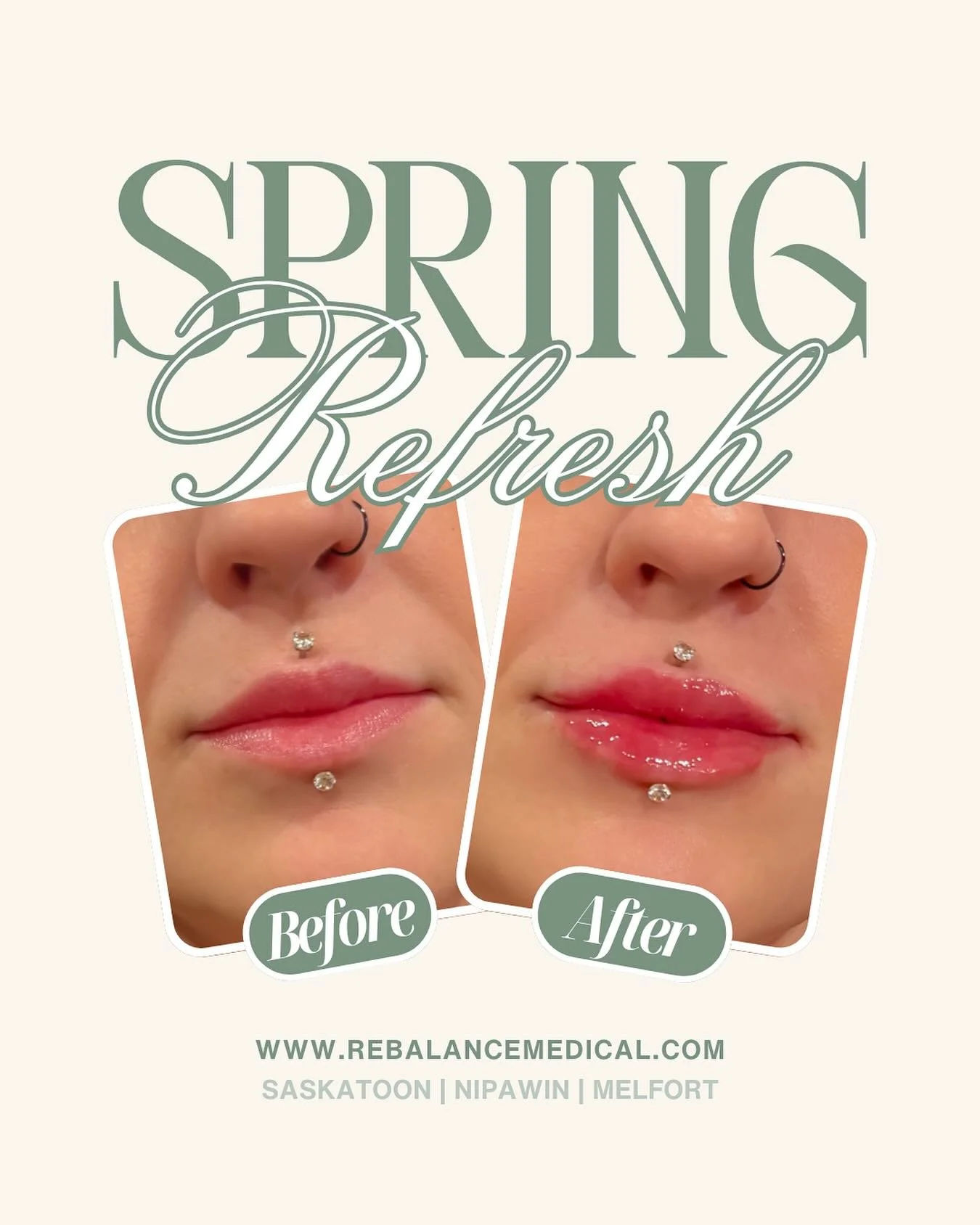 A little refresh for spring.  Soft, natural-looking lip enhancement that keeps you looking like you&mdash;just refreshed.
Schedule your lip filler appointment with ReBalance Medical.

#lipfiller #hafiller #dermalfiller #injections #injectables