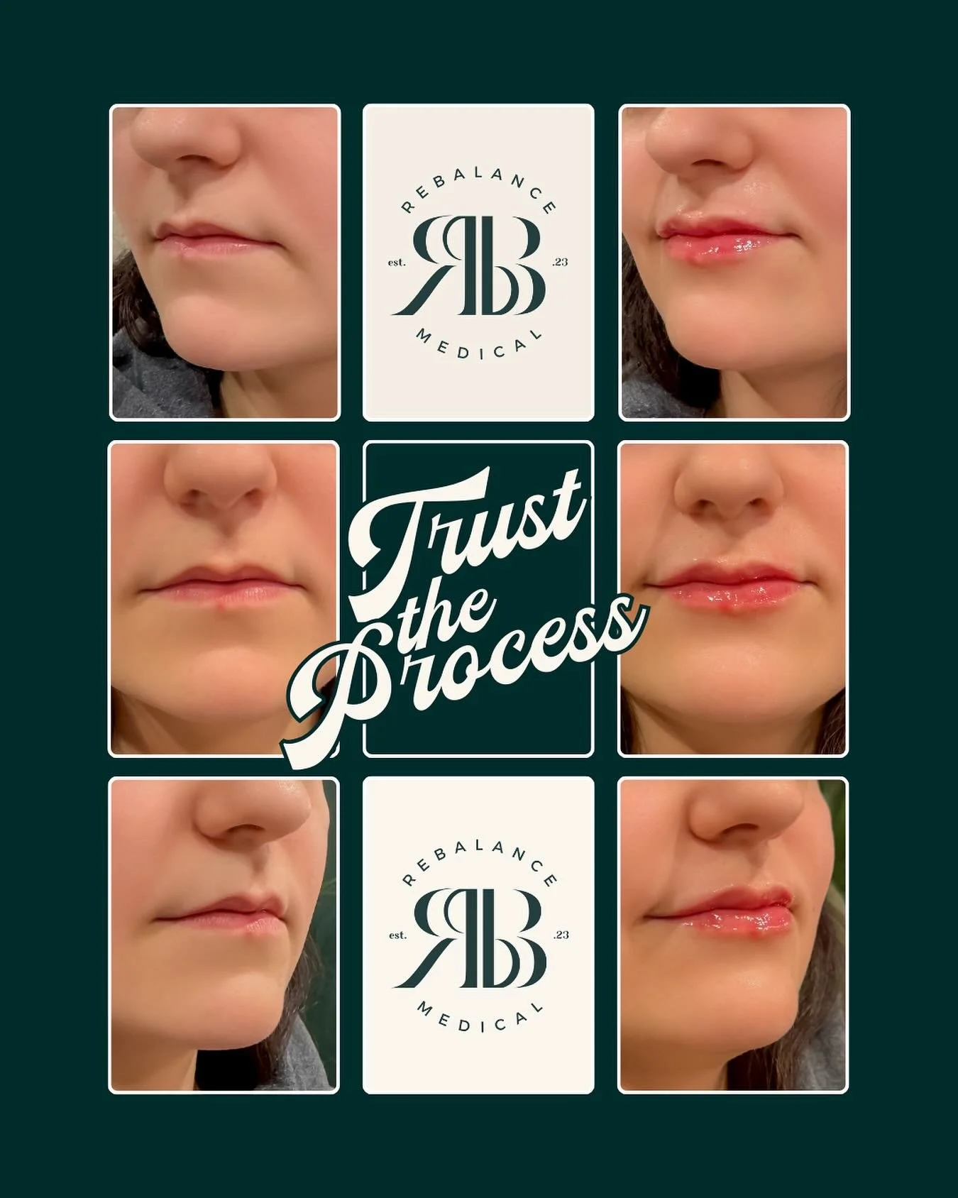 Some lips need a little strategy. Some need patience.
But with the right technique and a personalized plan&hellip; the results are worth it.
Trust the process. Start your lip journey with ReBalance Medical.

#lipfiller #fillers #dermalfiller #facialb