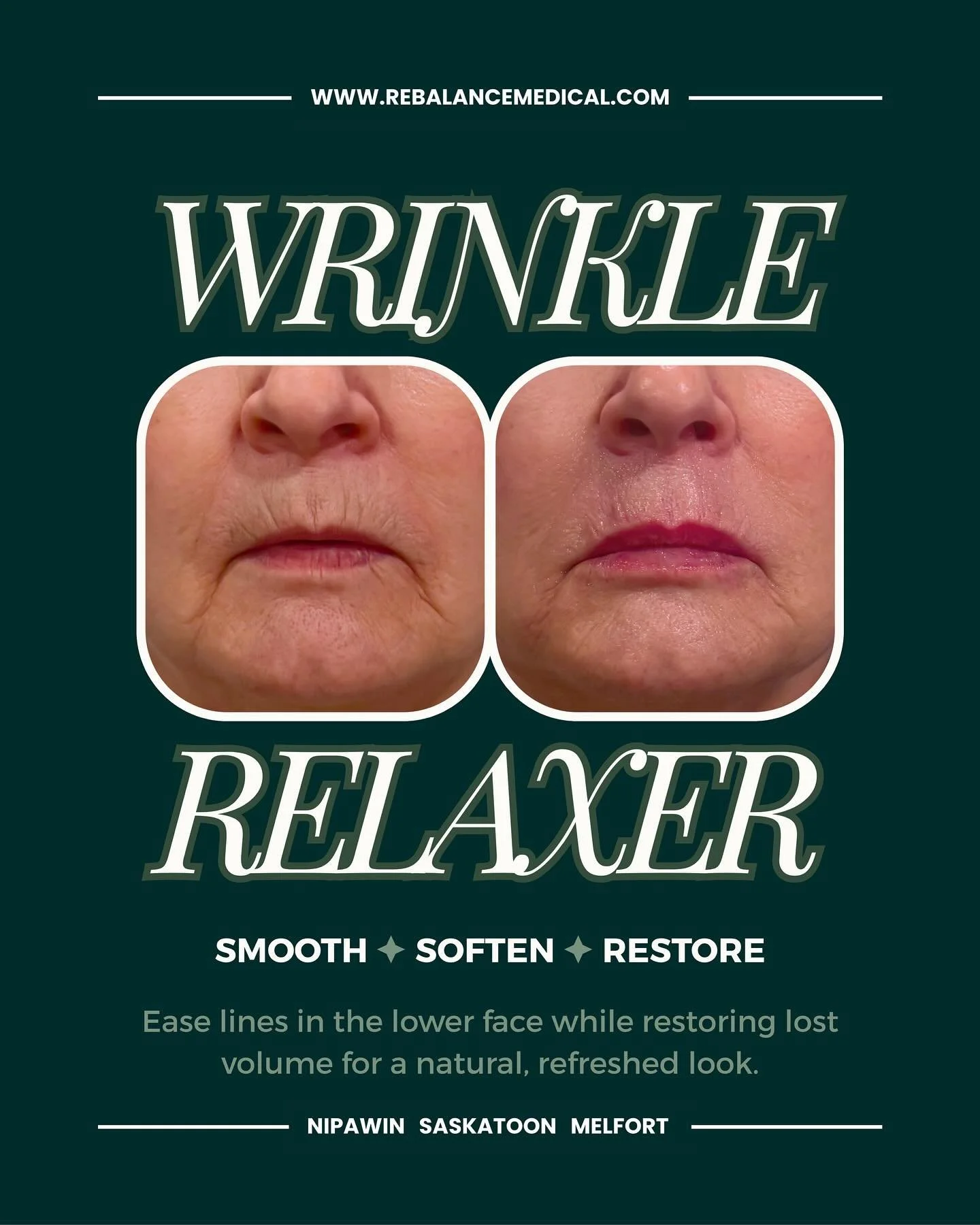 Lower face lines aren&rsquo;t just a &ldquo;wrinkle problem&rdquo; &mdash; they&rsquo;re often a combination of muscle movement and volume loss.

That&rsquo;s why we don&rsquo;t take a one-size-fits-all approach.
We use a customized combination of ne