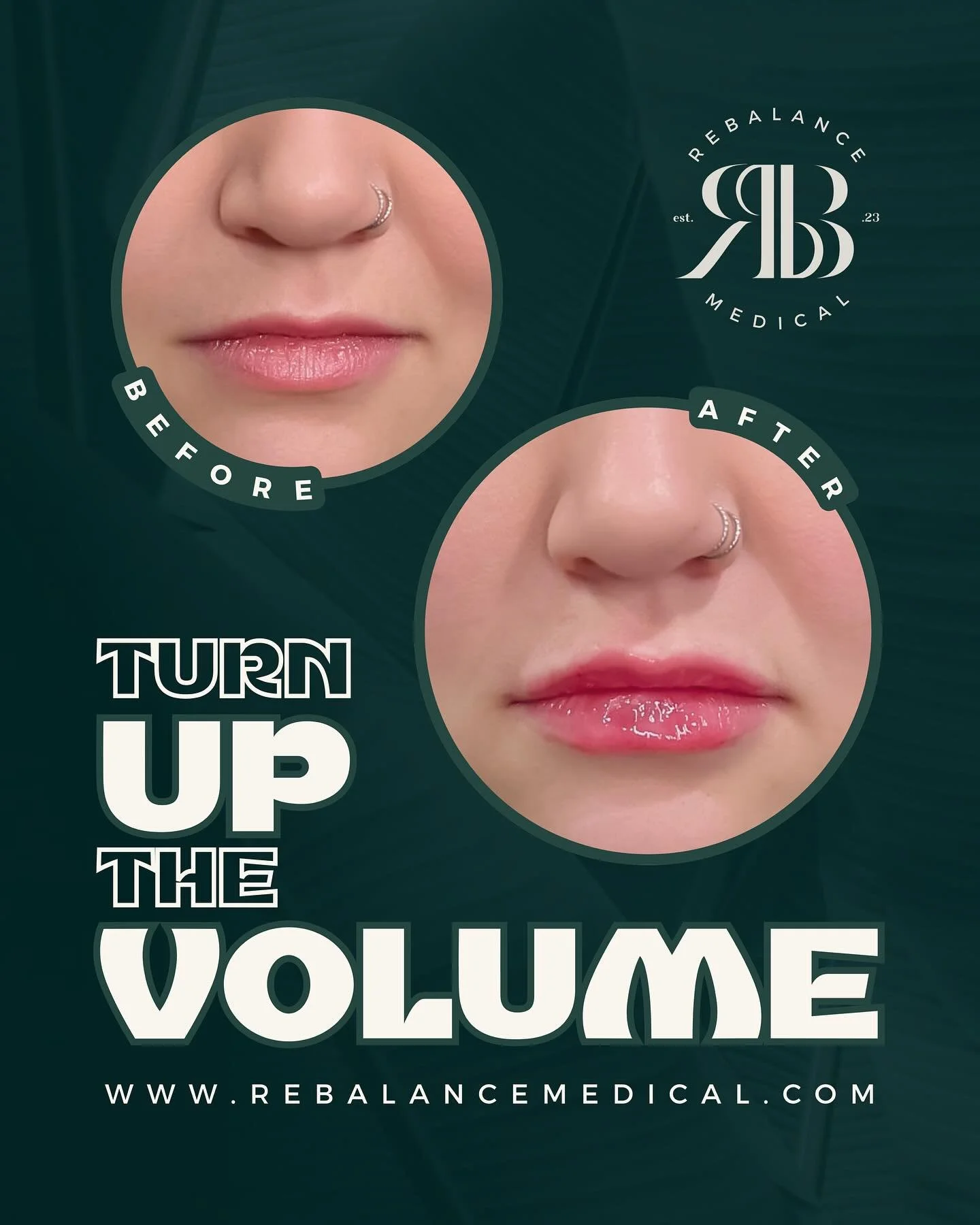 Whether you&rsquo;re looking for subtle enhancement or a fuller look, our customized lip treatments are designed to enhance your natural beauty with balanced, beautiful results.
Book your consultation today.

#filler #facialbalancing #fullfacerejuven