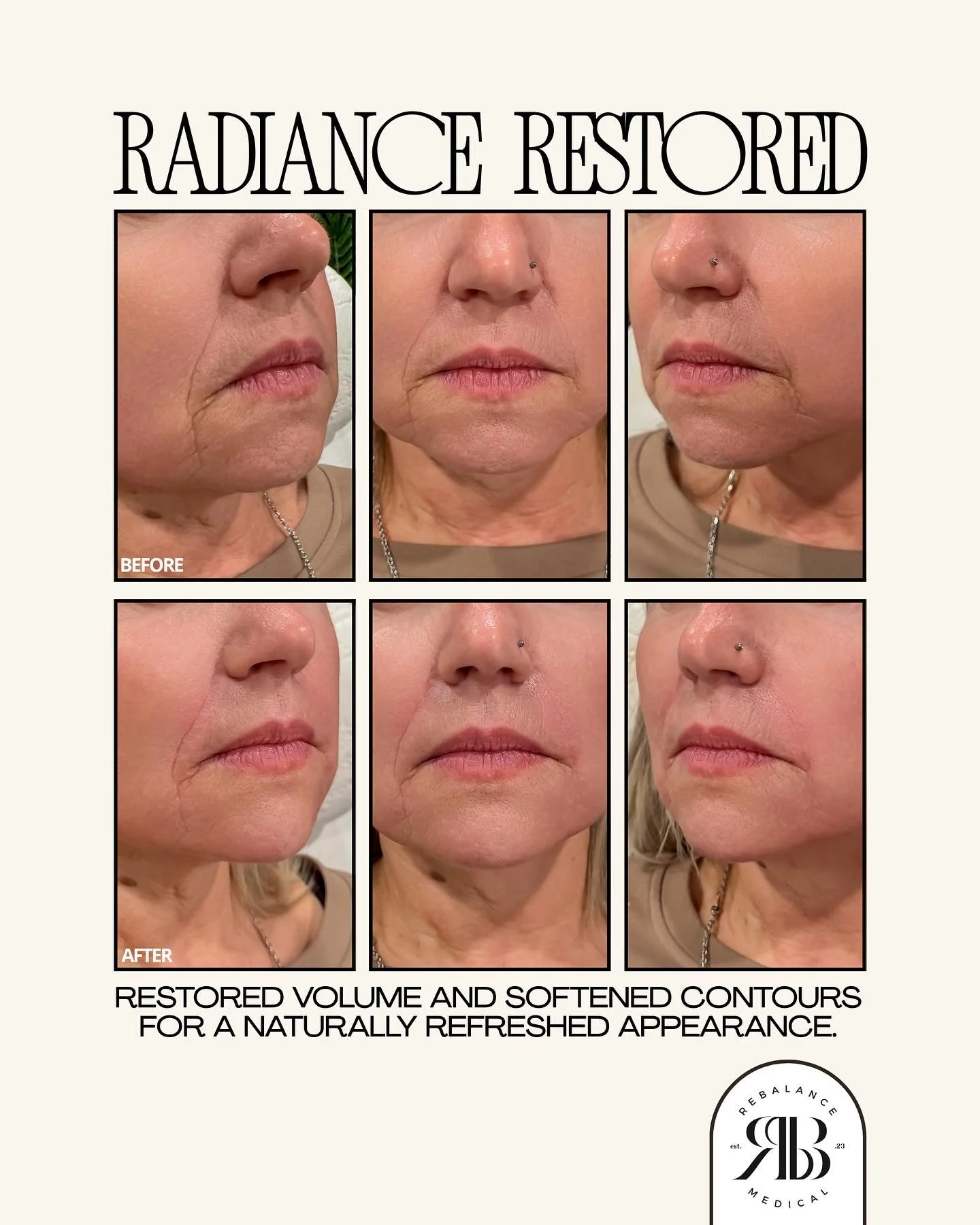 Dermal fillers are a non-surgical treatment designed to restore lost volume, smooth lines, and enhance facial contours that naturally change over time.
As we age, collagen, elastin, and facial fat gradually decrease, which can lead to hollowing, soft