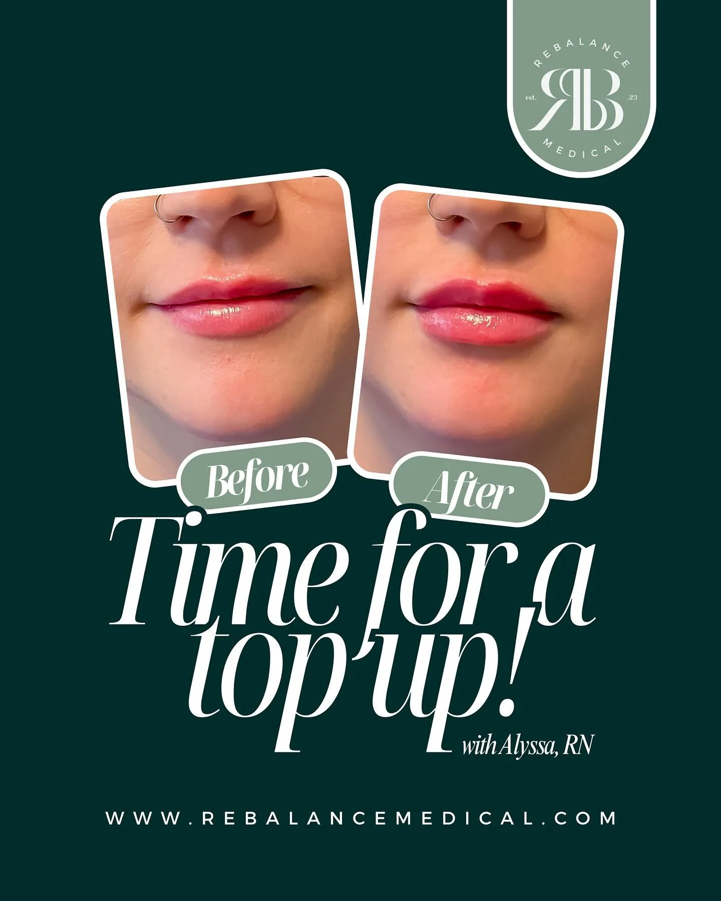 A little goes a long way.
Half a syringe of lip filler is a great option for patients looking to maintain results, refine shape, or add a subtle boost of hydration and volume without a dramatic change.
Top-up treatments are ideal for enhancing balanc