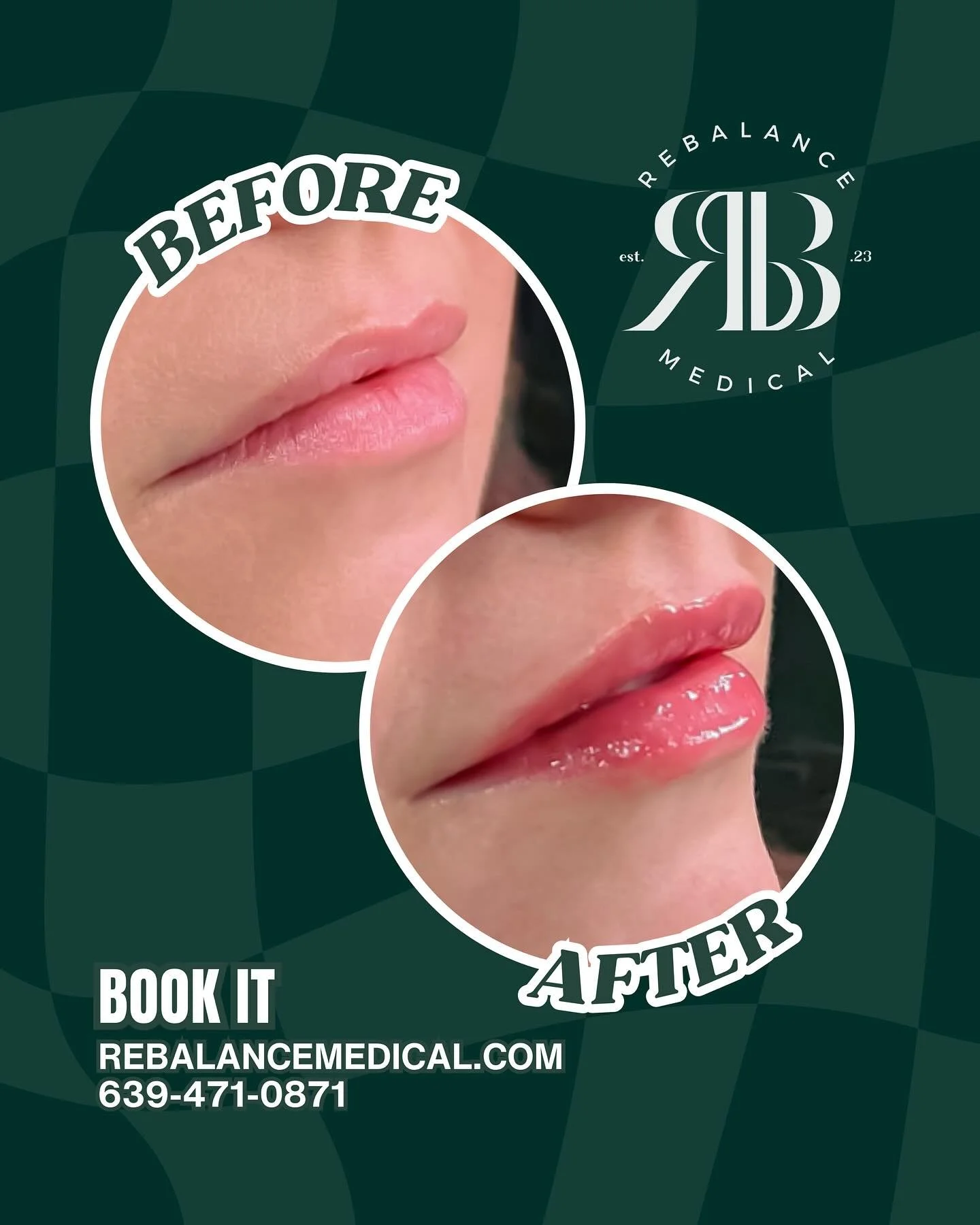 Fresh lips, fresh season!
A little lip filler can go a long way; adding soft volume, enhancing shape, and giving your look that extra boost for summer.
Whether you&rsquo;re after a subtle refresh or a little more pout, we&rsquo;re here to help you ac