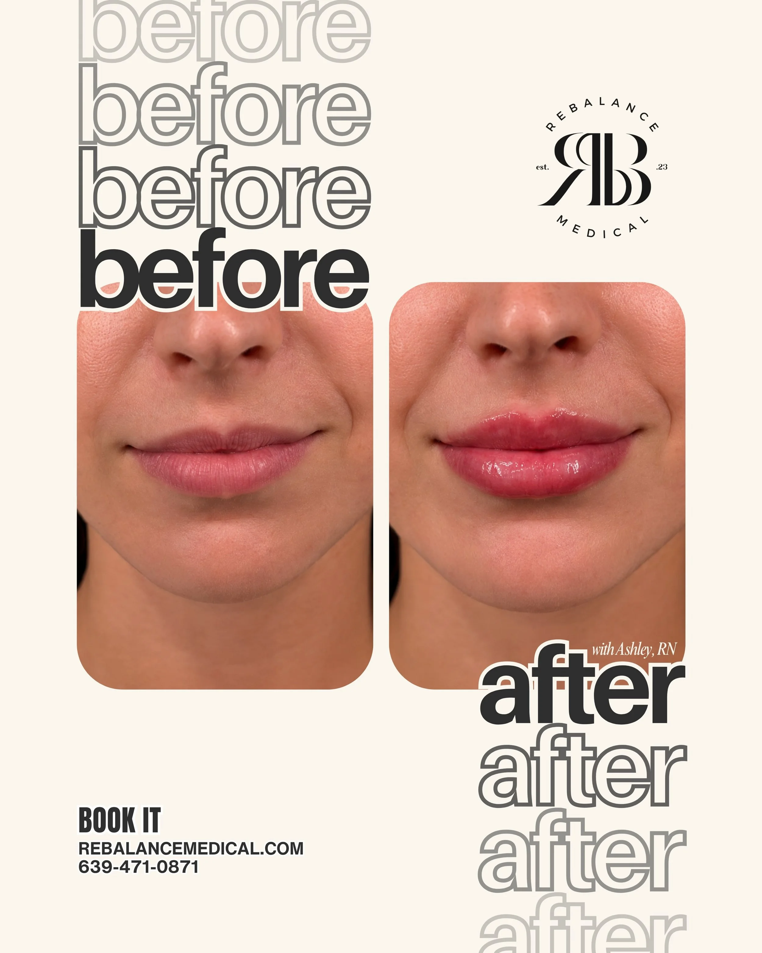 Lip filler is about so much more than adding volume.

When performed with a personalized approach, lip filler can enhance your natural shape, improve symmetry, restore volume that&rsquo;s been lost over time, and create smoother, more hydrated-lookin