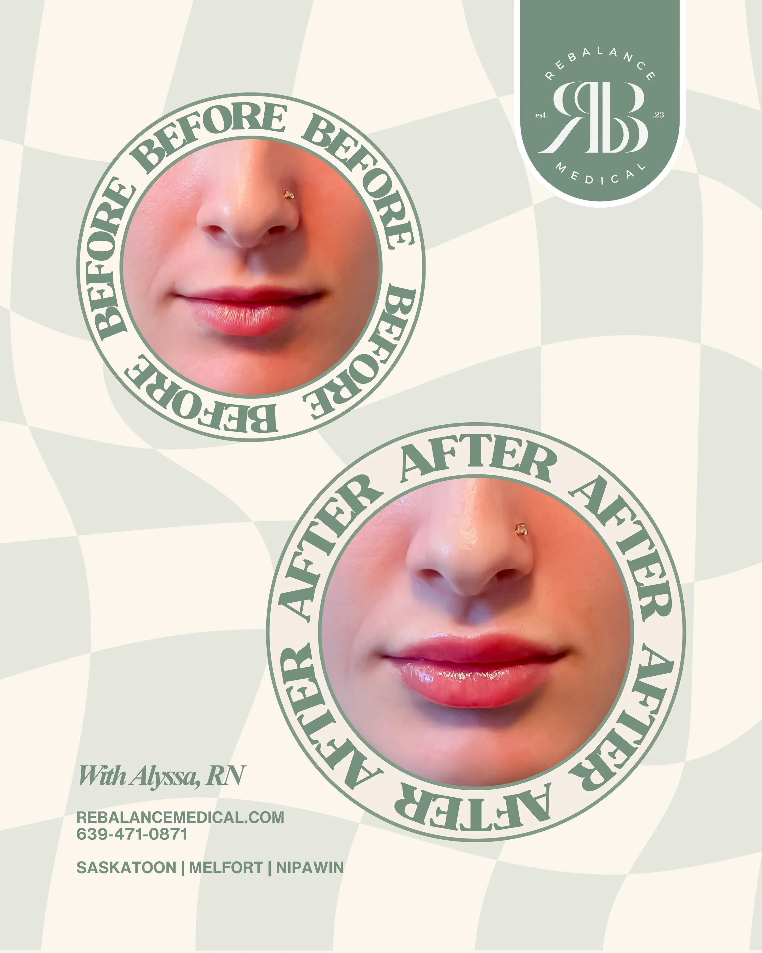 No two lips are the same, so your treatment shouldn&rsquo;t be either. Whether you&rsquo;re after a subtle refresh or a little extra definition, Alyssa, RN creates personalized results that enhance your natural beauty&mdash;never overpower it.

Book 