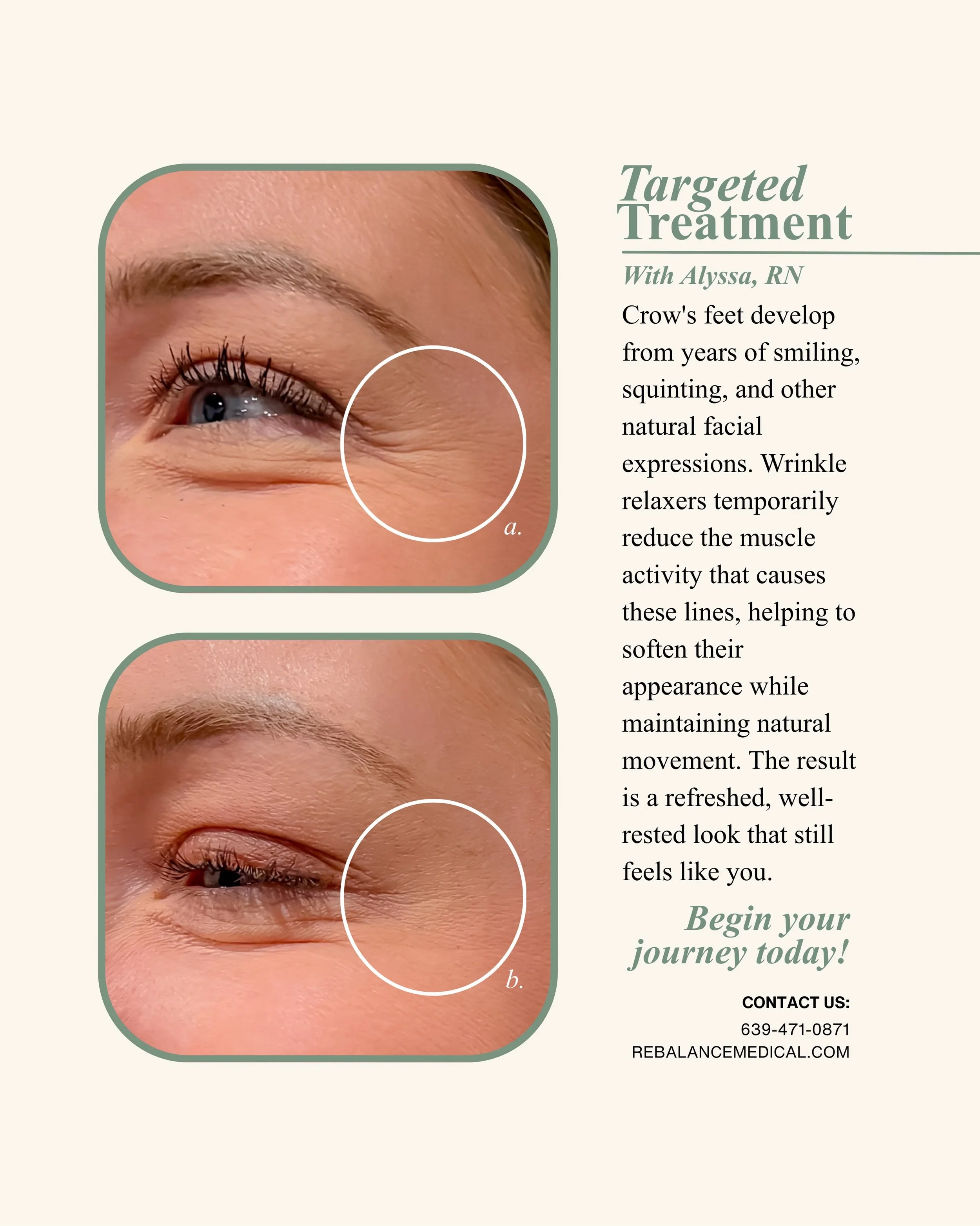 Keep your natural expressions while softening the look of fine lines. A refreshed, well-rested appearance starts with a personalized approach.
Book your consultation today to learn more.

#botox #wrinklerelaxer #crowsfeet #agelessbeauty #beautyroutin