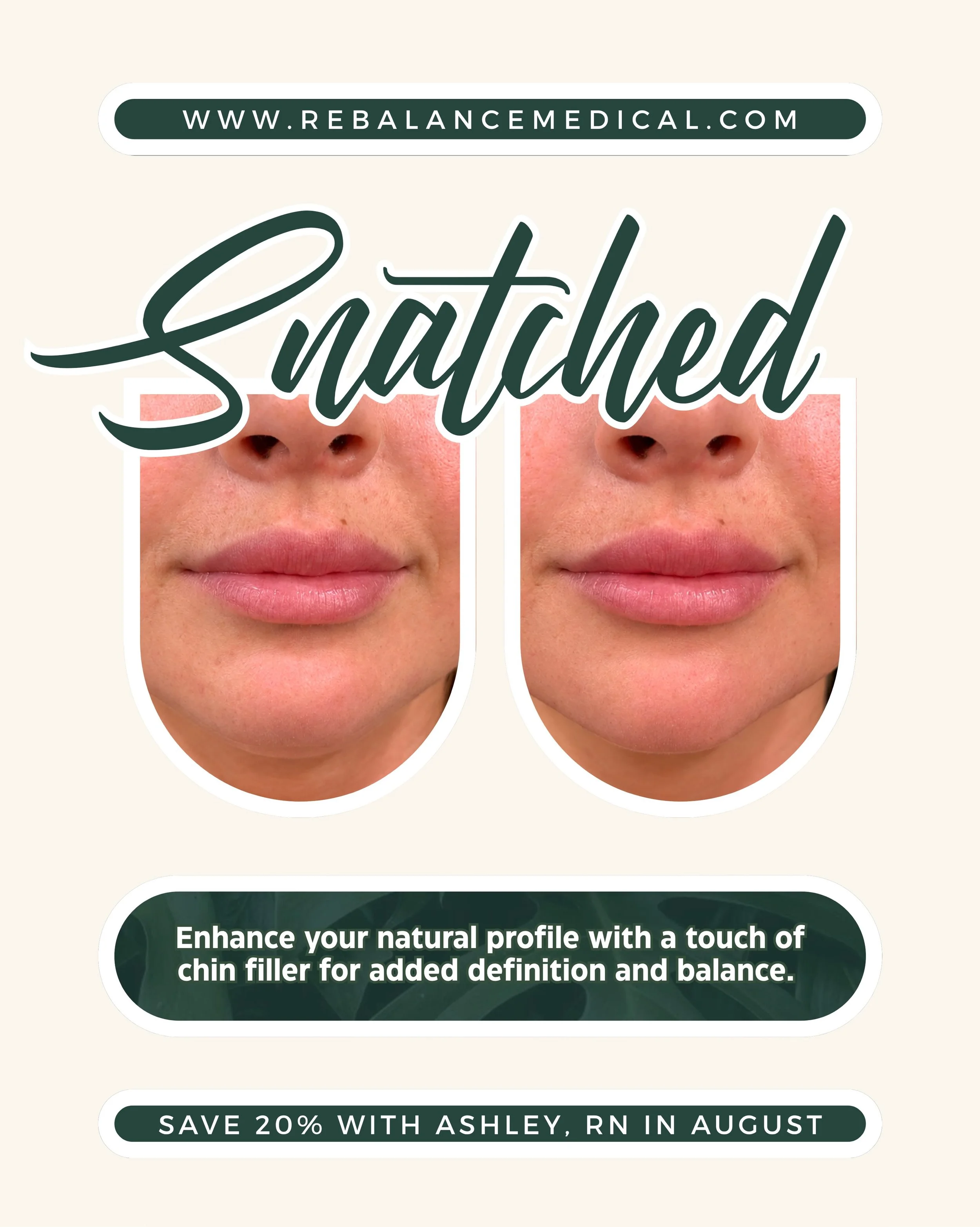 Enhance your natural profile with a touch of chin filler for added definition and balance. 
Curious if chin filler is right for you? Book your no obligation consultation with our team today!

SAVE 20% with Ashley, RN until August 31st!

#filler #chin