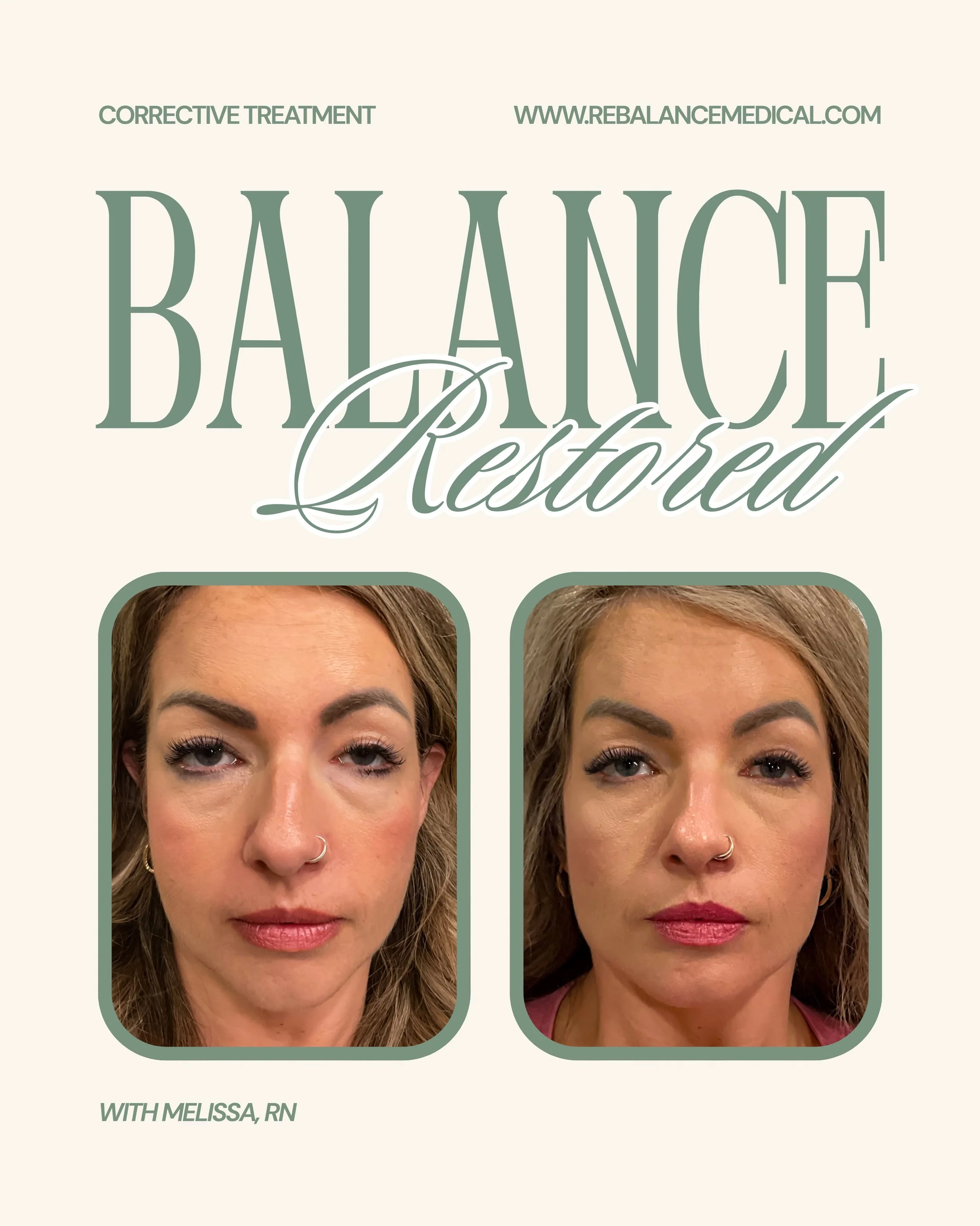 After surgery affecting our client&rsquo;s left eye, we focused on creating a more balanced, harmonious appearance. We used a small amount of tox to help improve brow symmetry, followed by cheek filler and tear trough filler to restore volume and sof