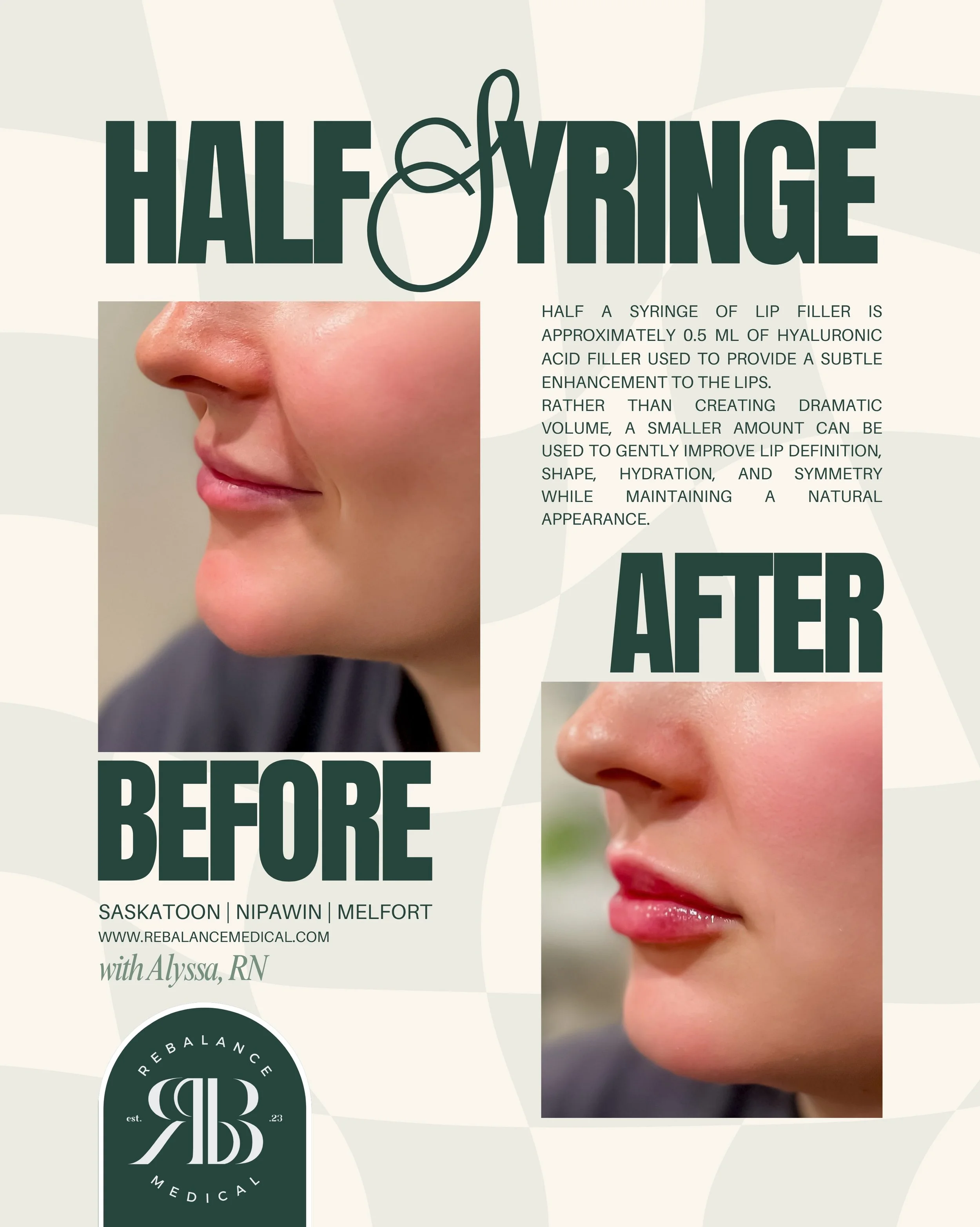 Not everyone needs a full syringe.
The amount of filler needed is unique to each person and depends on your natural anatomy, previous filler, and desired result. A half syringe can be a great option for those looking for a soft, subtle enhancement or
