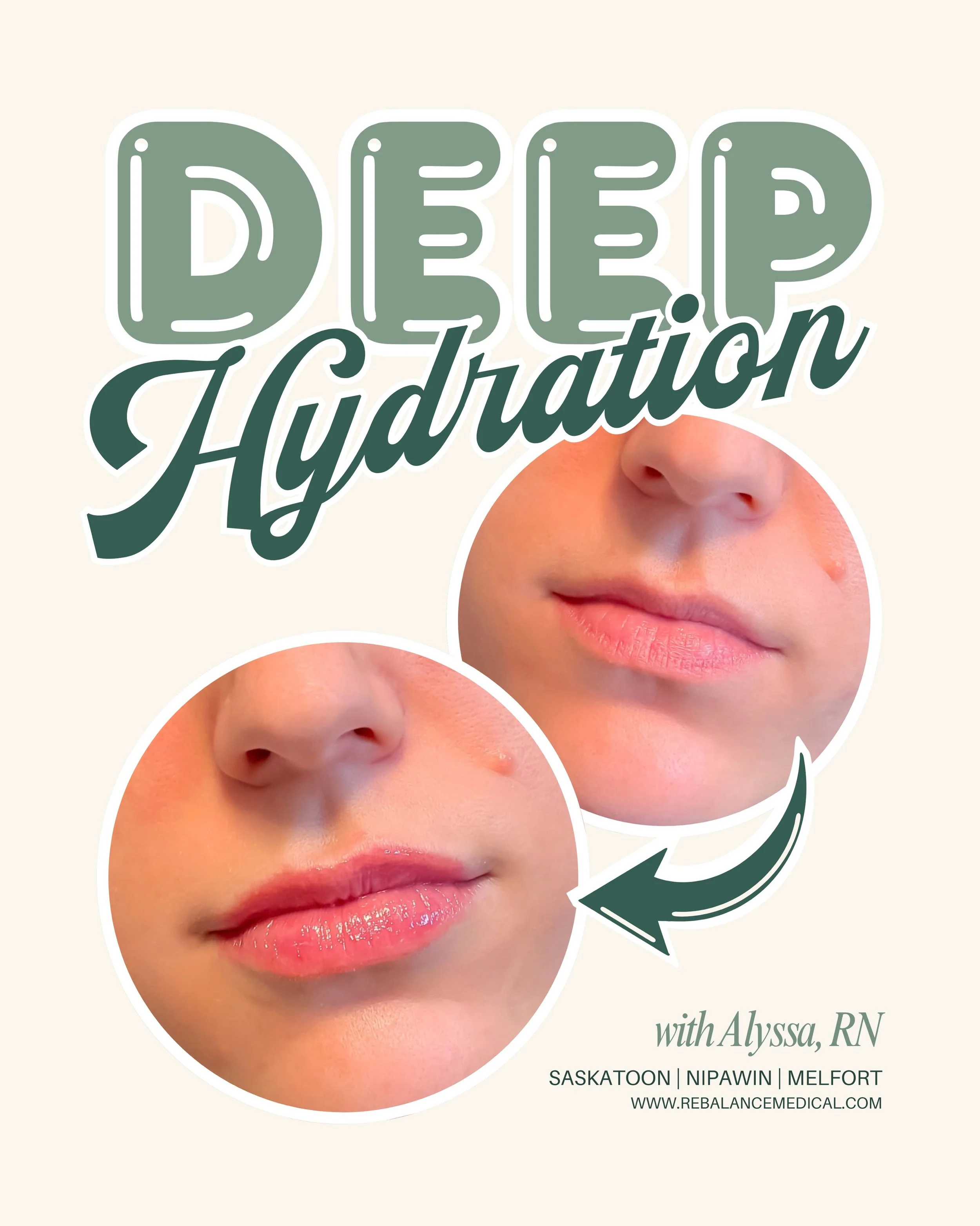 Hydration meets beautiful, natural-looking lips.
Hyaluronic acid (HA) is a naturally occurring substance that attracts and holds water. When used in lip filler, HA can help enhance lip volume and definition while contributing to a softer, smoother, m