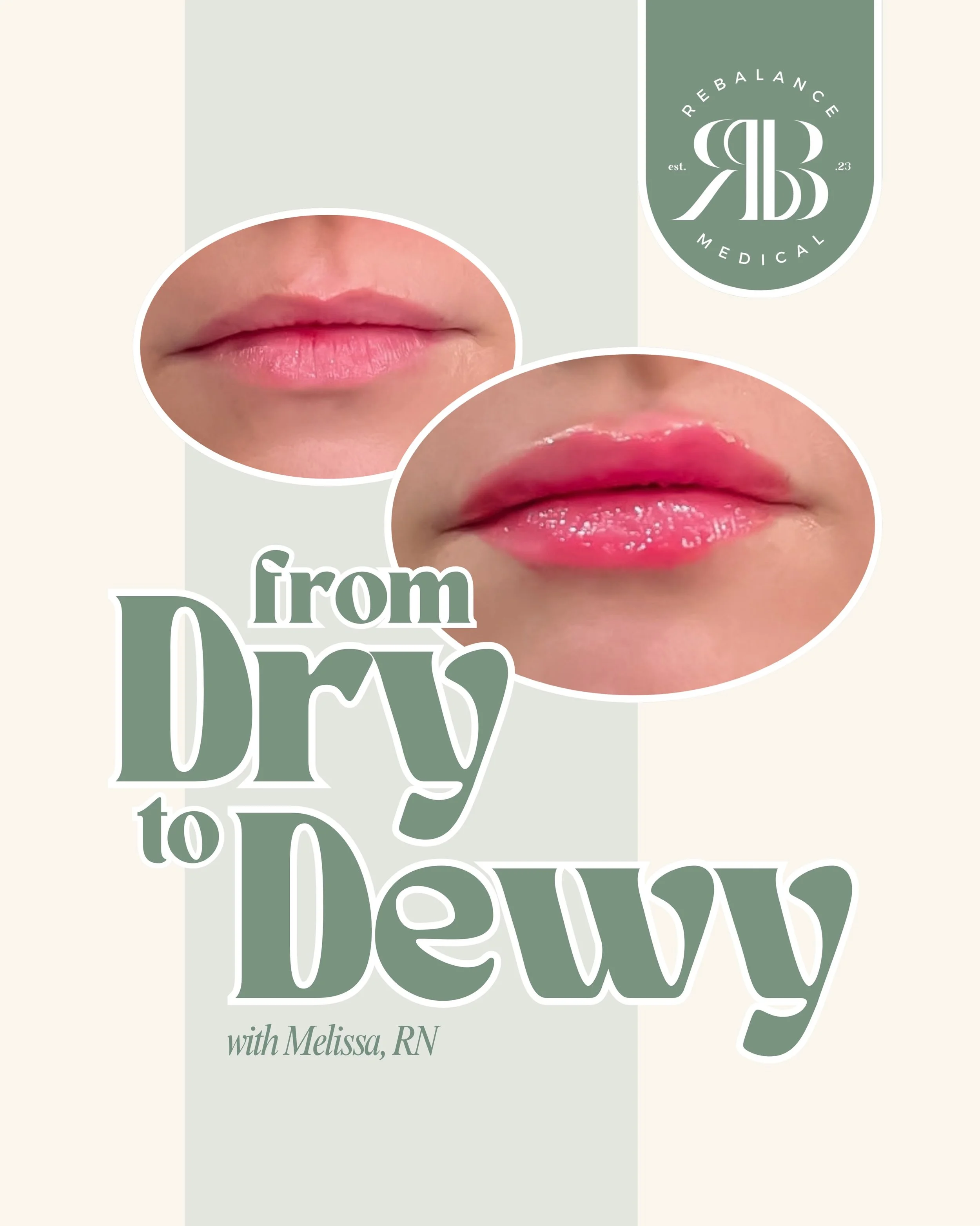 Proof that subtle moves make the biggest impact.
If you&rsquo;ve been nervous about trying lip filler, our girl Melissa has the gentle touch you need. She took these lips from dry to dewy with a two-step approach: an initial half syringe to softly hy