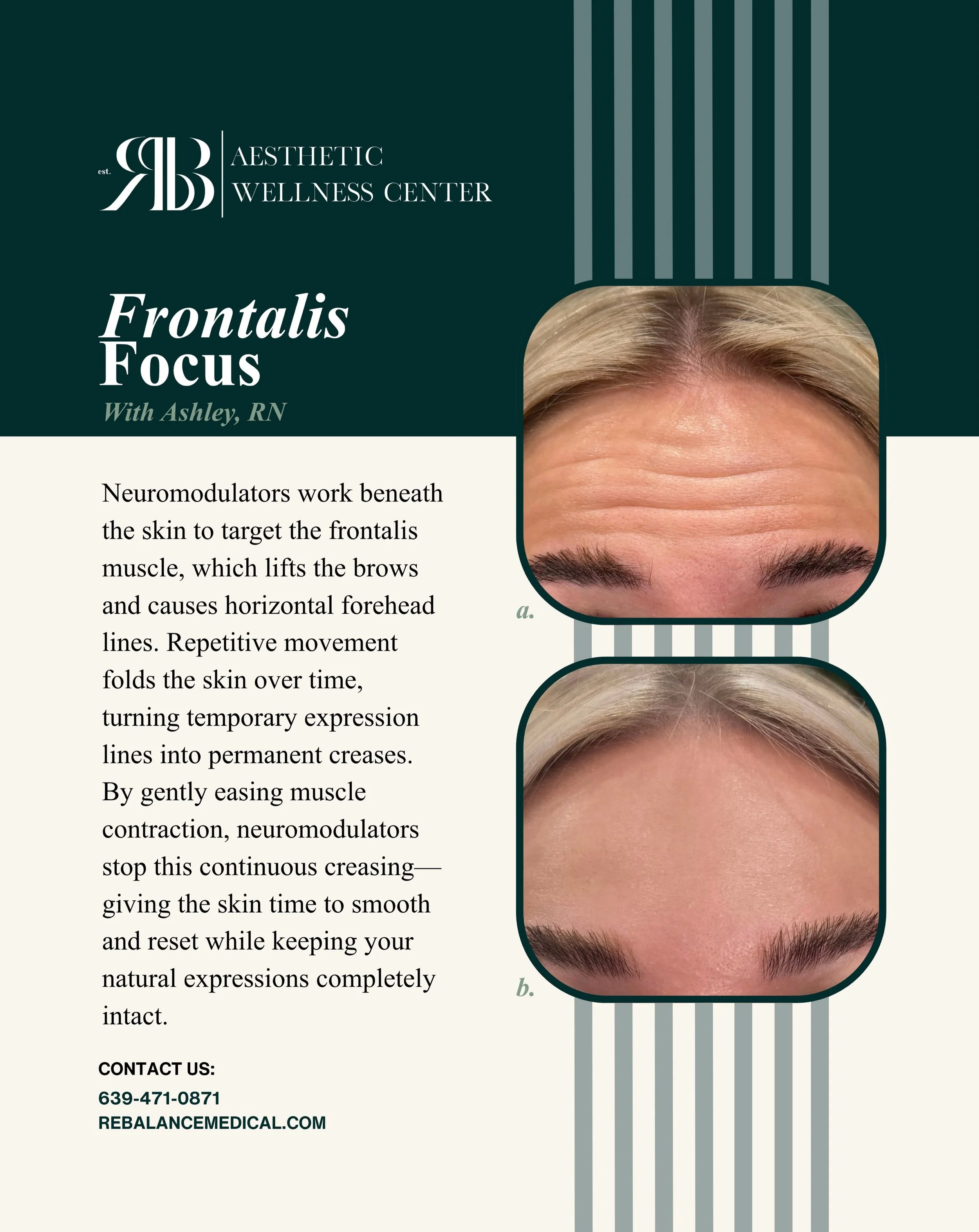 A little break for your frontalis muscle goes a long way.
If you&rsquo;ve noticed horizontal forehead lines lingering even when your face is at rest, neuromodulators can help reset the surface. By calming the underlying muscle contractions, the skin 