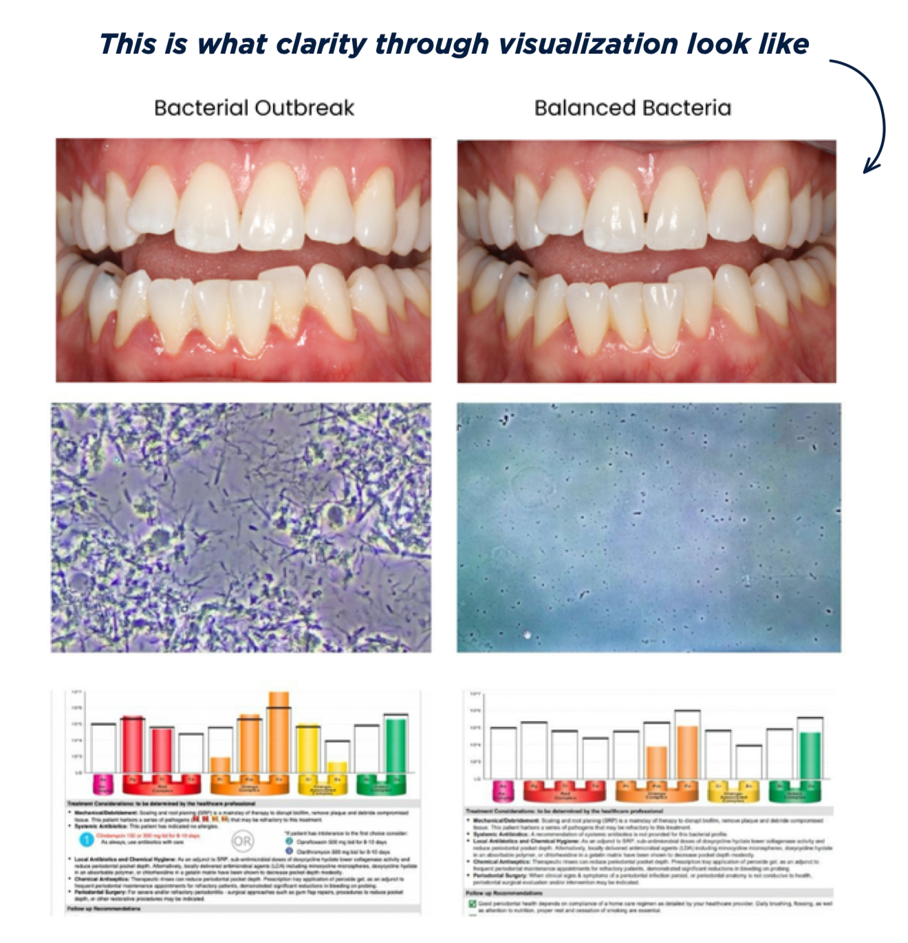 Comparison of bacterial outbreak and balanced bacteria using gum photos, phase contrast microscopy, and DNA-PCR results