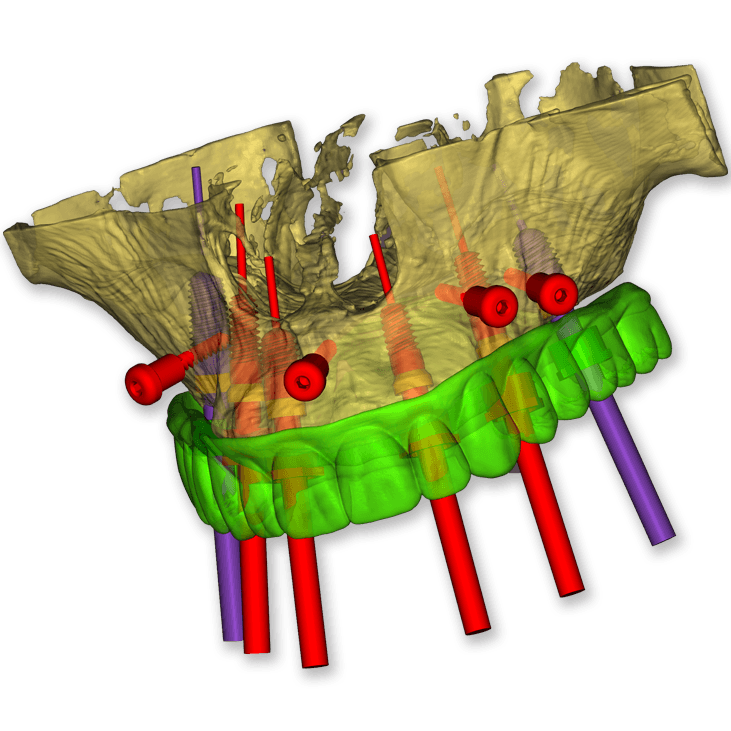 Surgical guide planning services in partnership with ITX Pros.