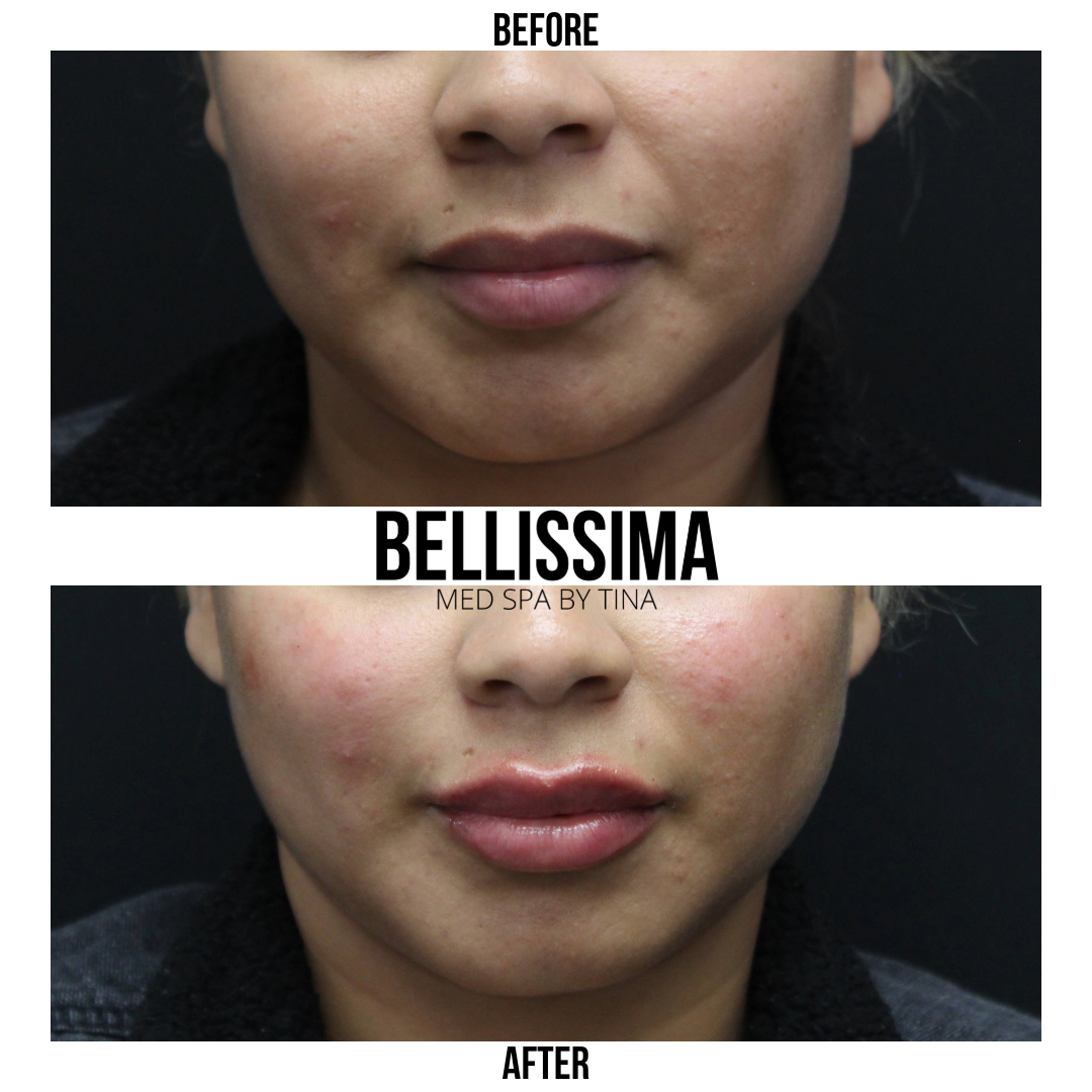 Case 16 Lip filler