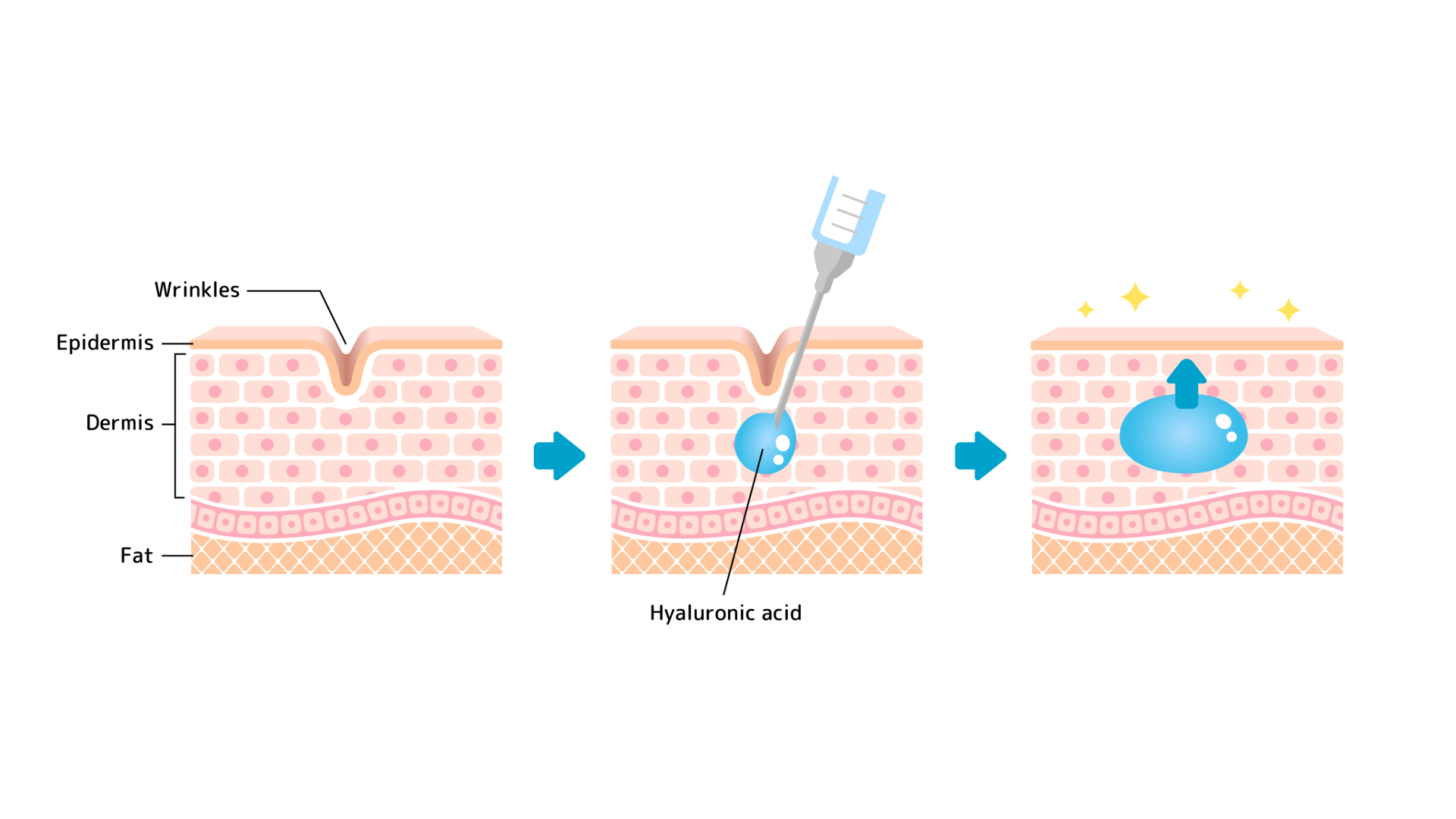 Biostimulators vs. Hyaluronic Acid Fillers: What’s the Difference and Which is Right for You?