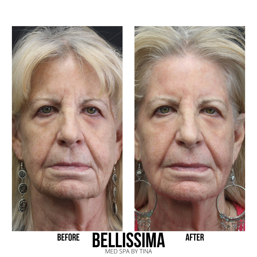 Case 39 Skin resurfacing with CO2 Laser