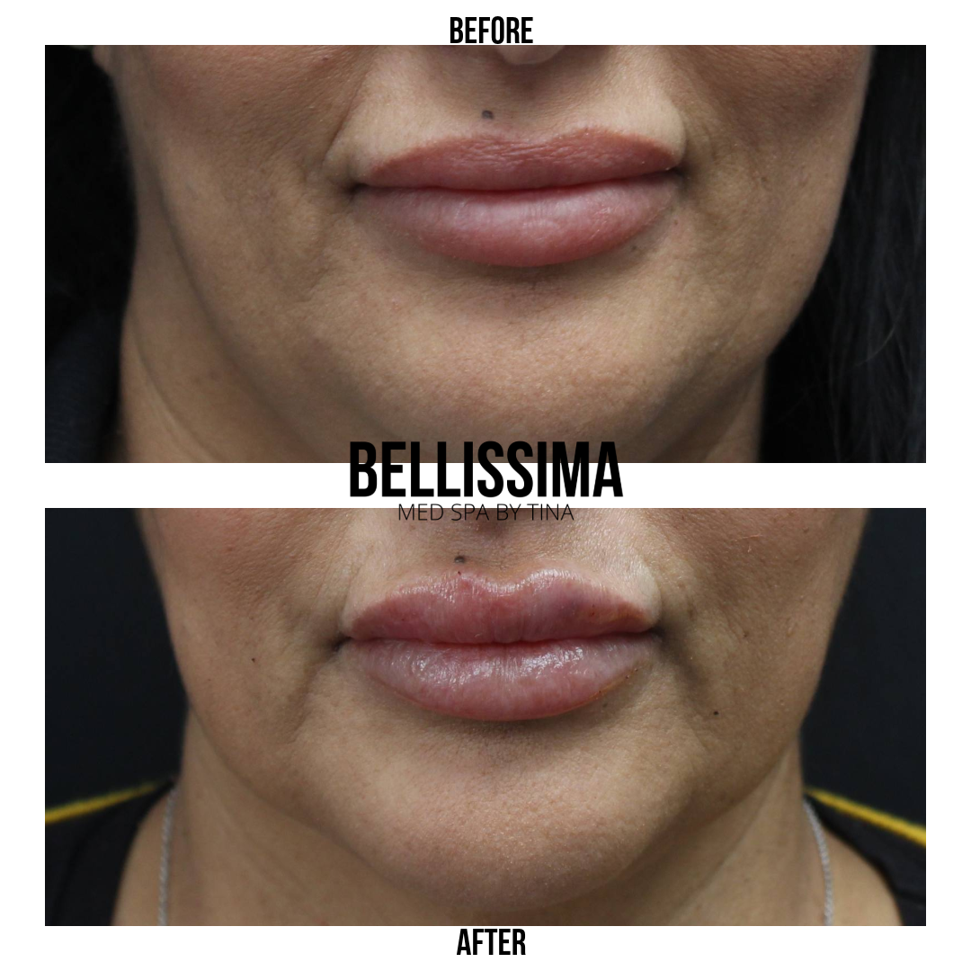 Case 36 Lip filler
