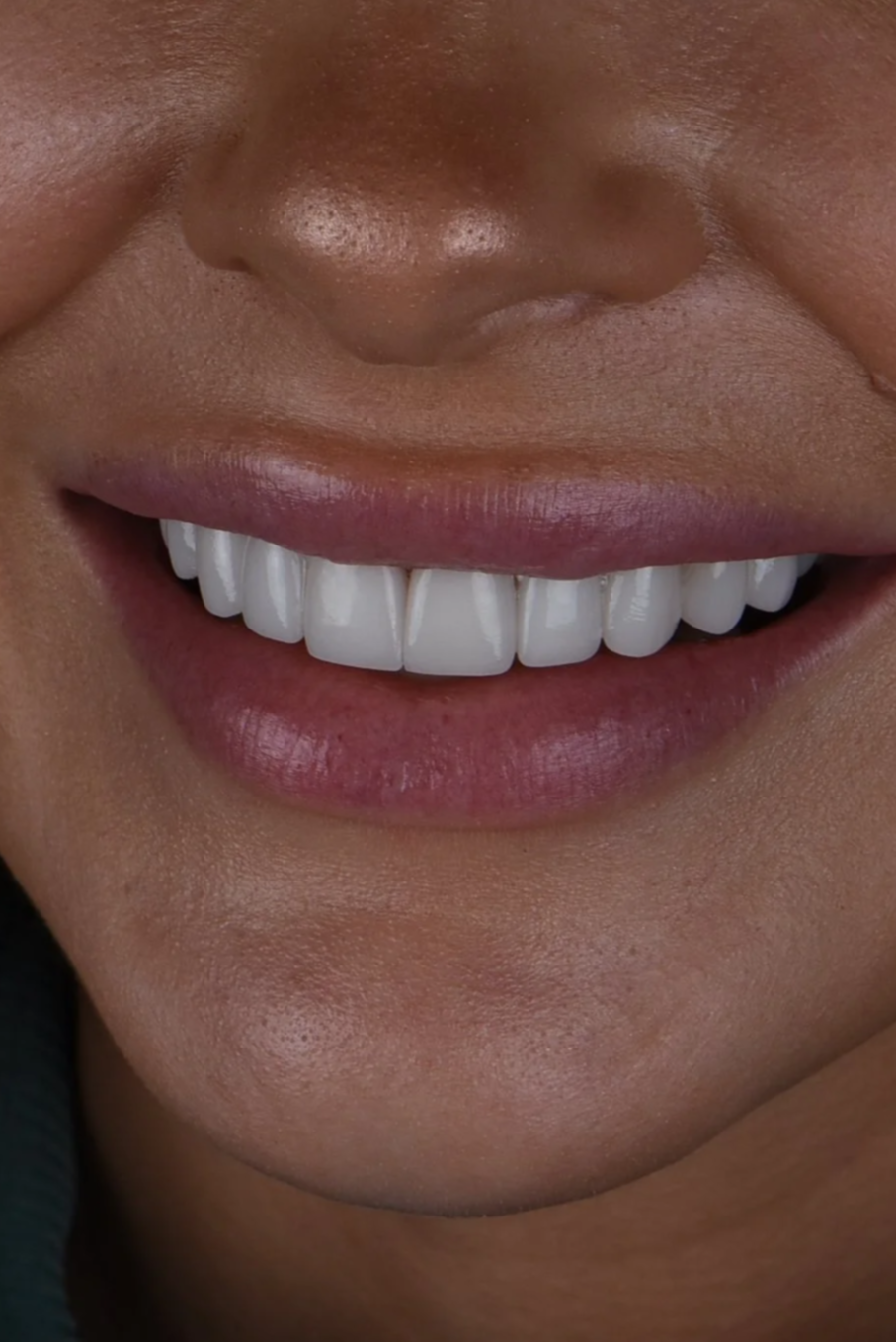 Close-up of a person's smile showing white teeth and lips.
