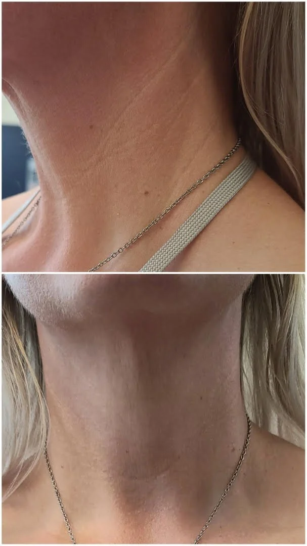 Human+Derived+Growth+Microneedling+treatment.jpg