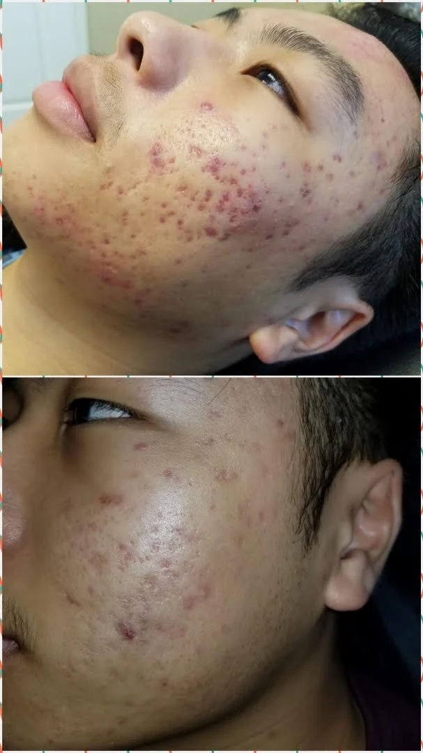 2+Viva+for+acne+image+1of2.jpg