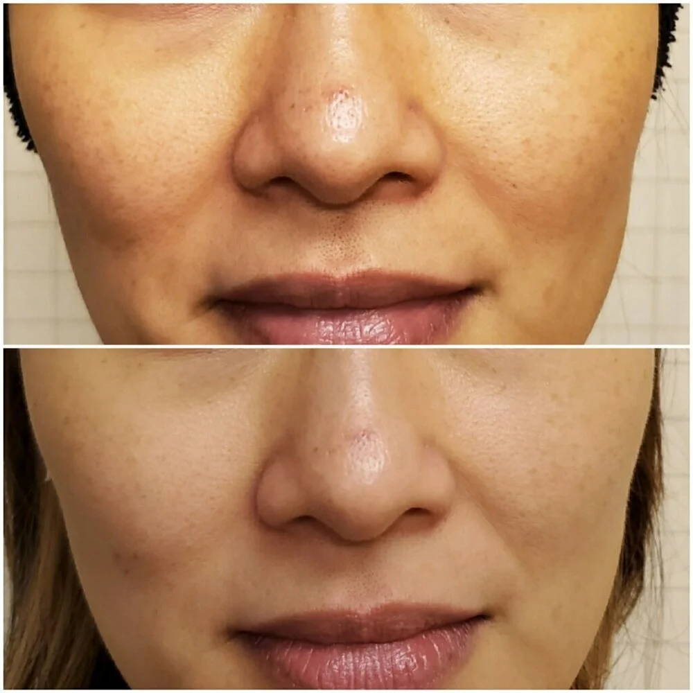micro laser peel 2.jpg
