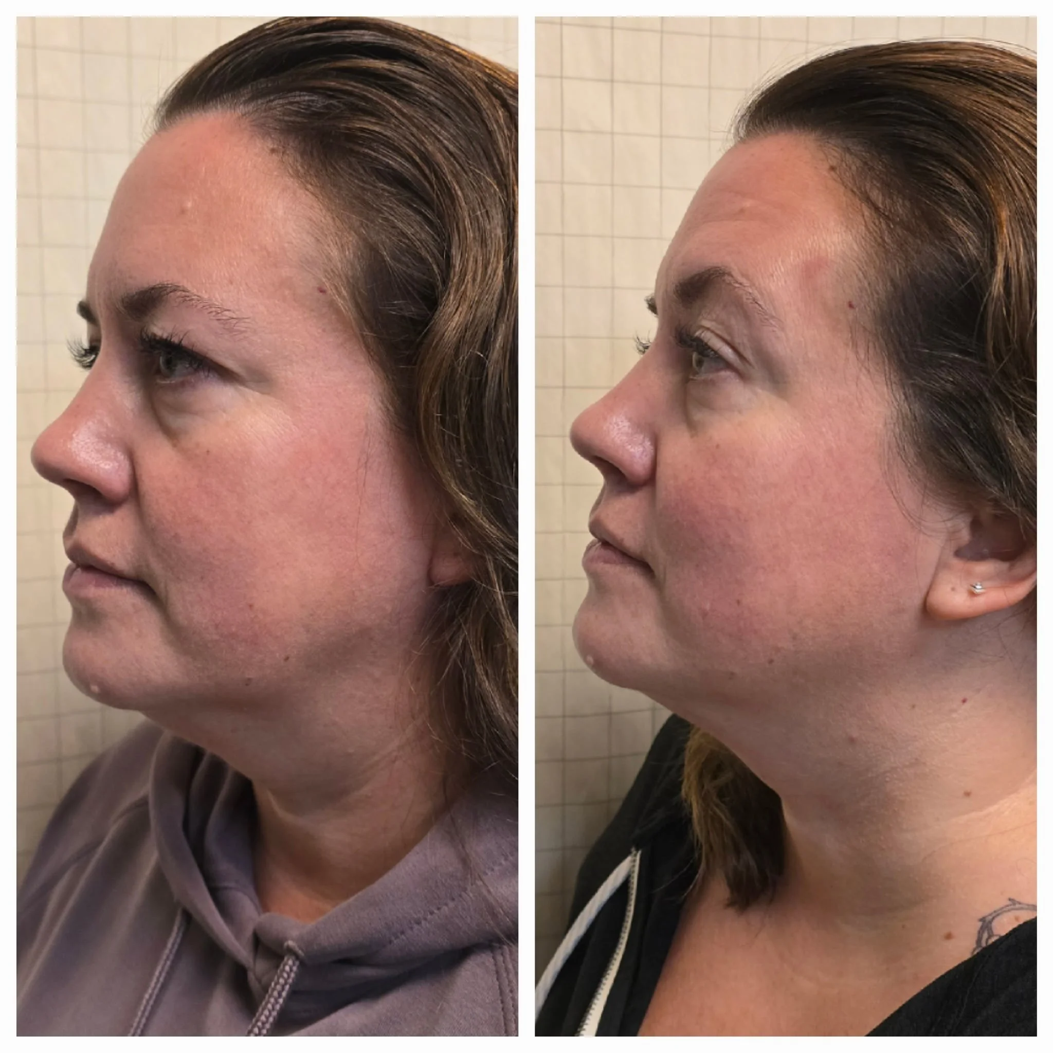 improve your skin with emface.JPG