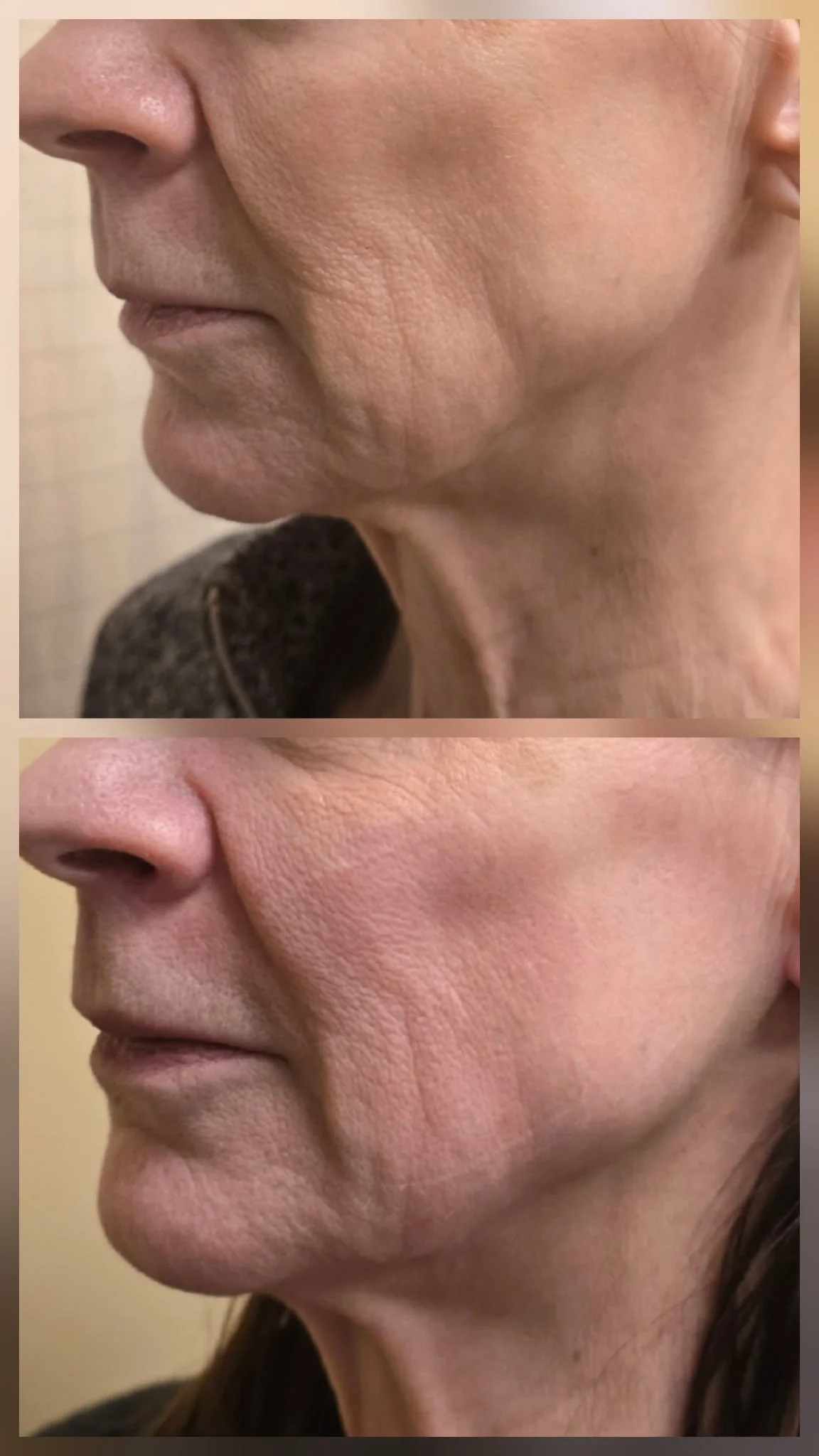emface stunning results.JPG