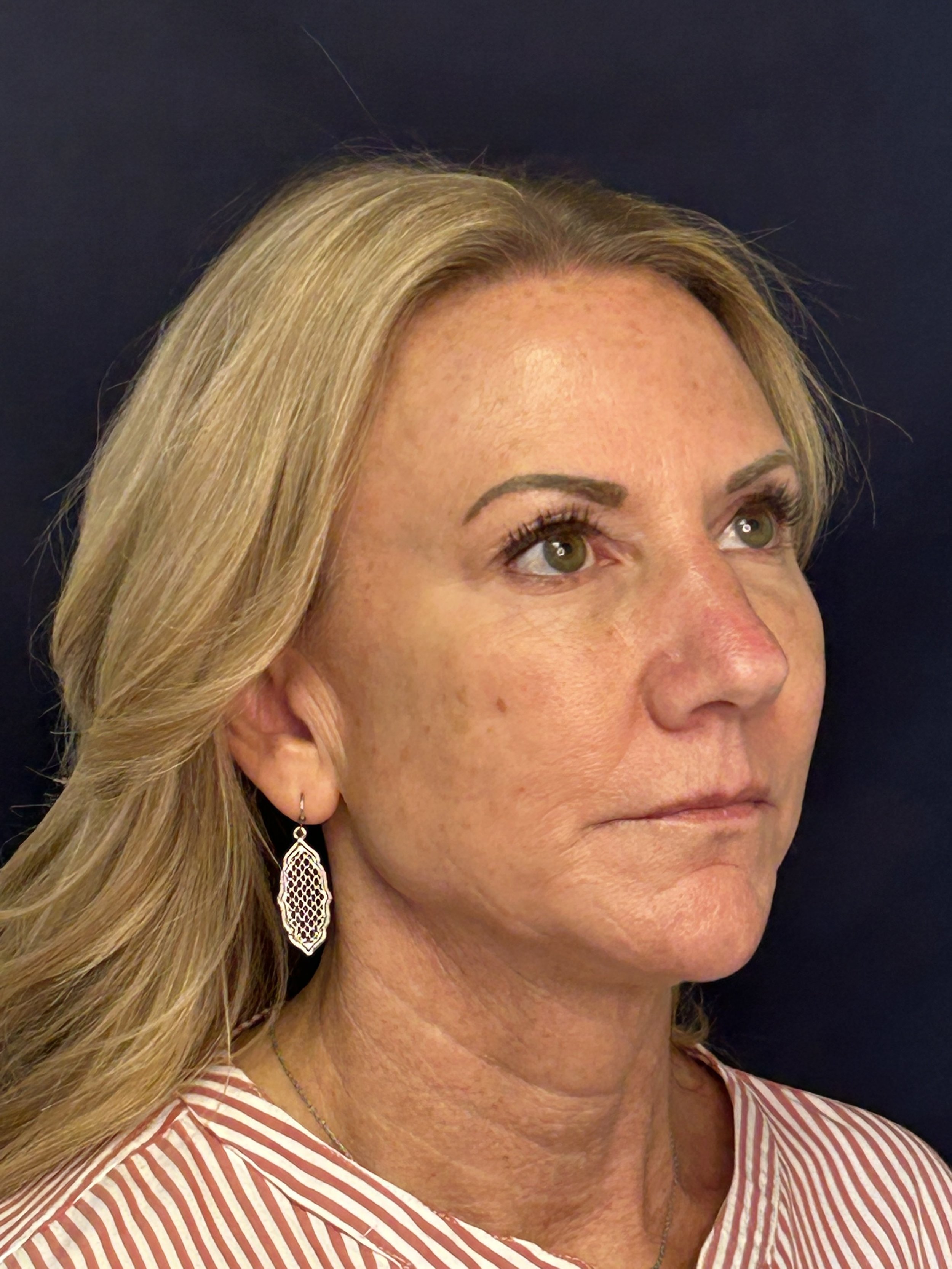 After ; RHA 4; RHA 3 and Redensity filler to Temples, Cheeks, and Chin