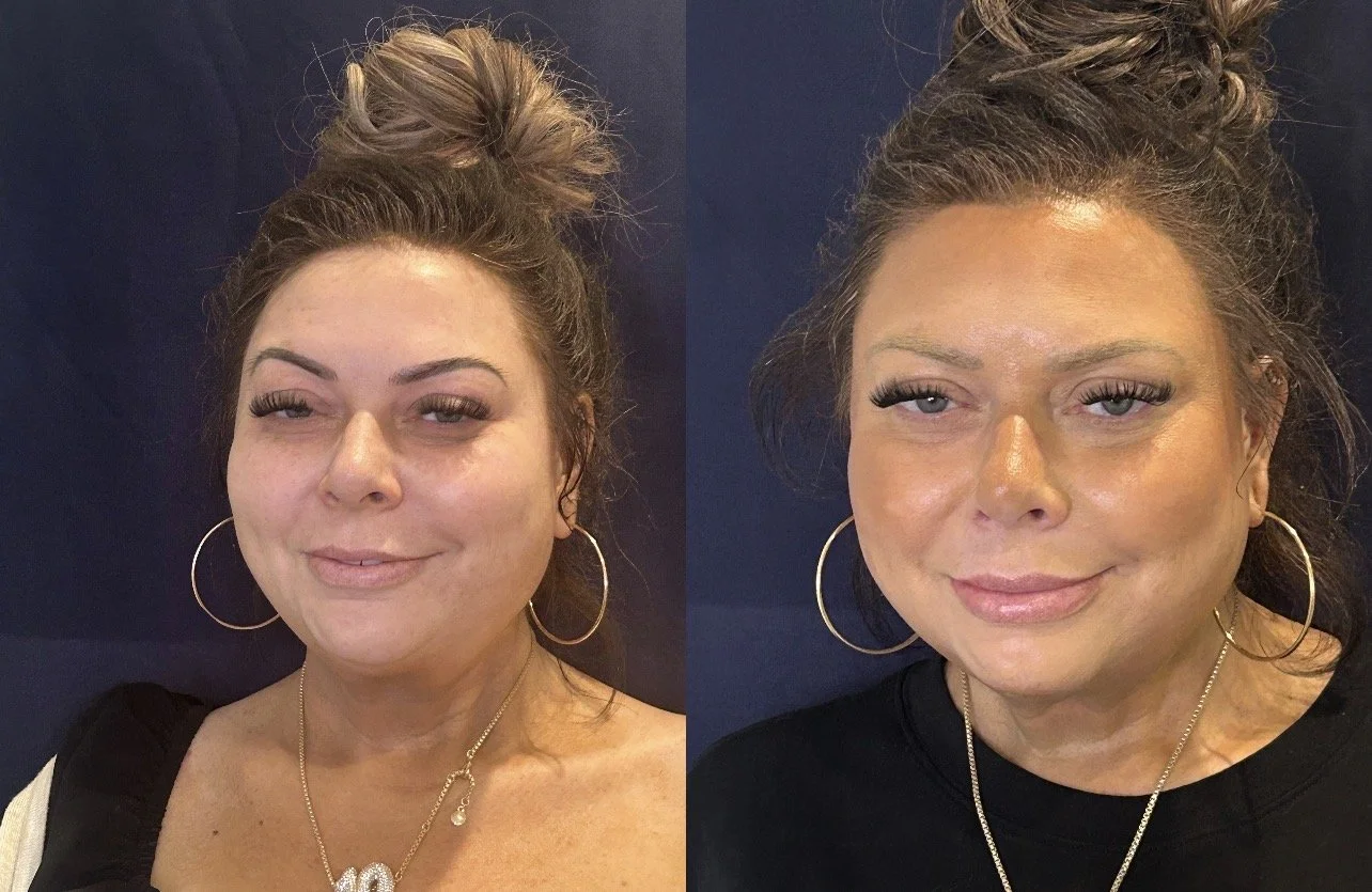 Chin and Jawline filler
