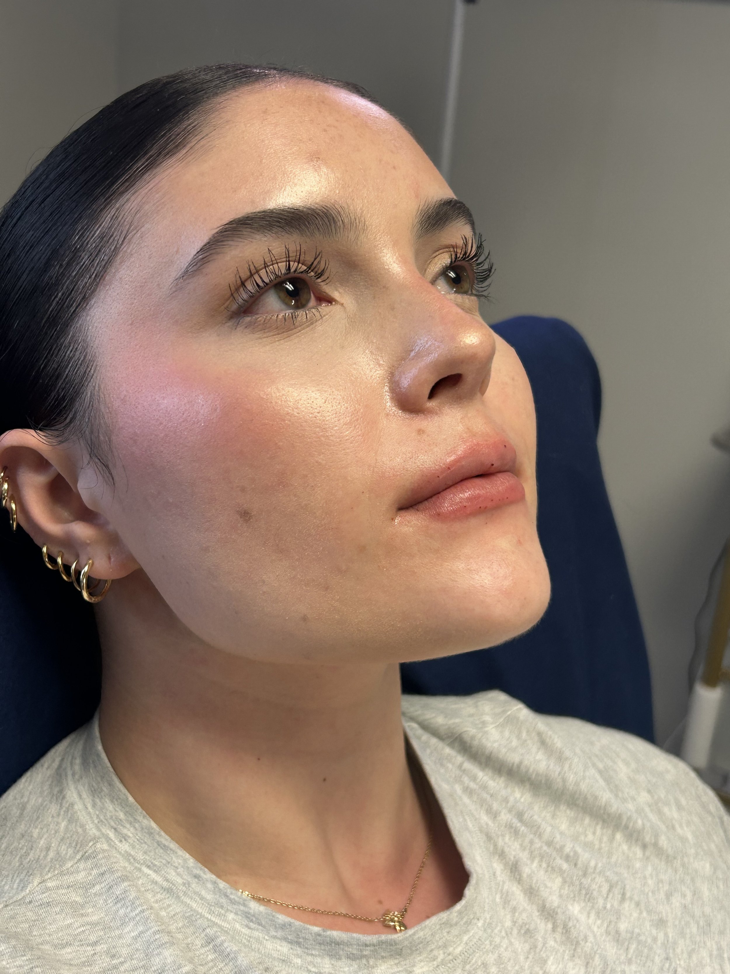 After Juvederm Ultra XC lip filler